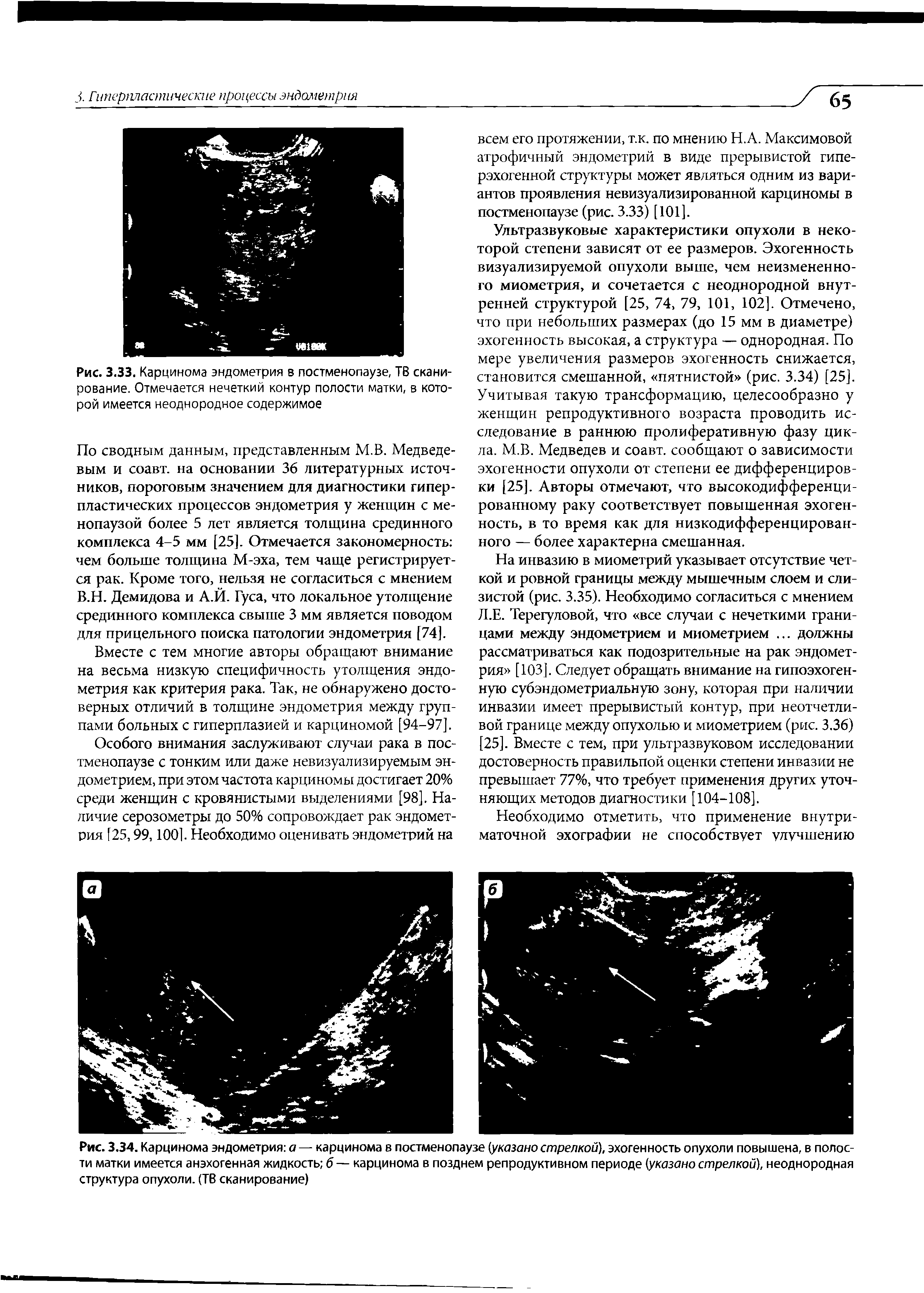 Рис. 3.34. Карцинома эндометрия а — карцинома в постменопаузе (указано стрелкой), эхогенность опухоли повышена, в полости матки имеется анэхогенная жидкость б— карцинома в позднем репродуктивном периоде (указано стрелкой), неоднородная структура опухоли. (ТВ сканирование)...