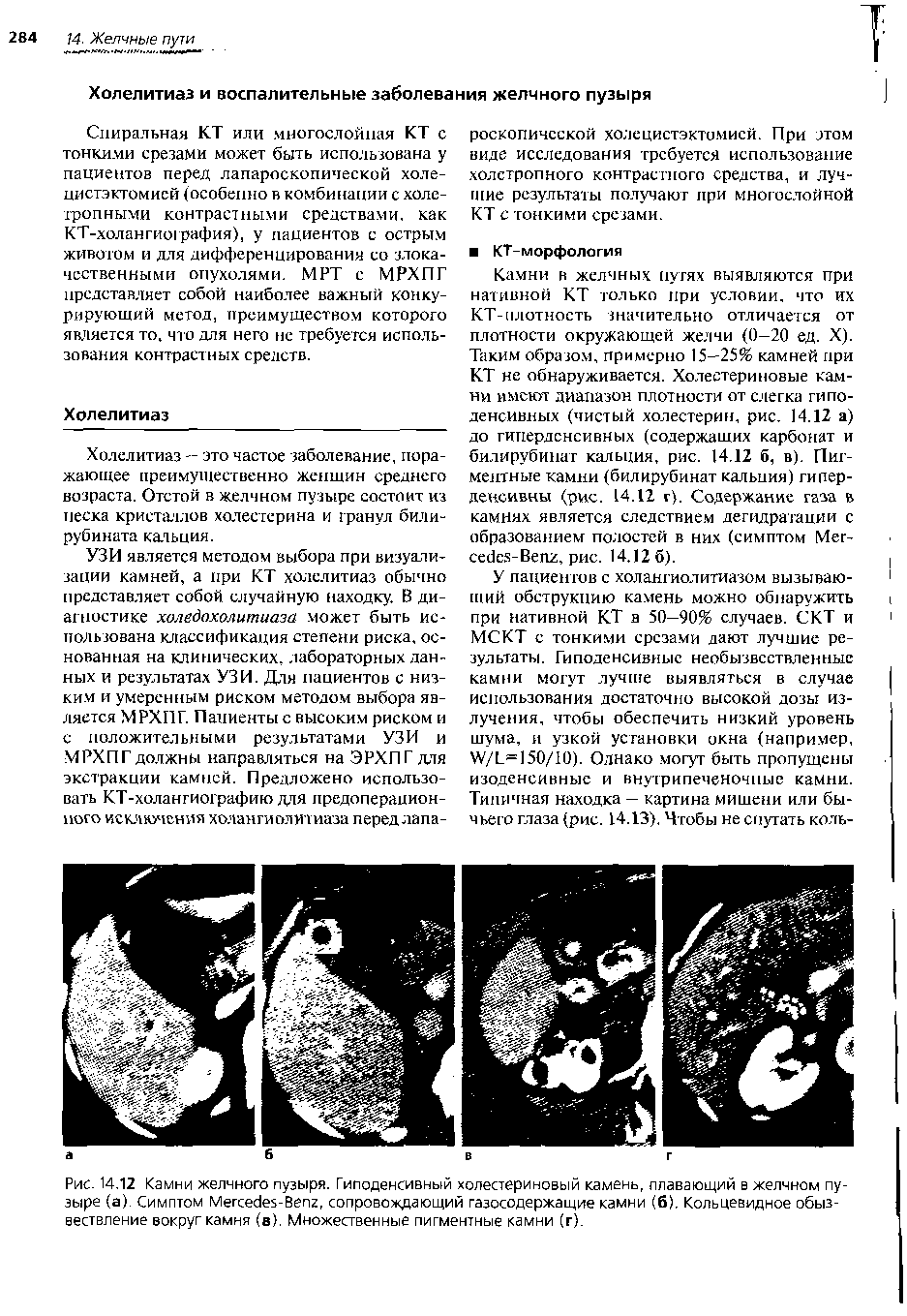 Рис. 14.12 Камни желчного пузыря. Гиподенсивный холестериновый камень, плавающий в желчном пузыре (а) Симптом M -B , сопровождающий газосодержащие камни (б). Кольцевидное обызвествление вокруг камня (в). Множественные пигментные камни (г).