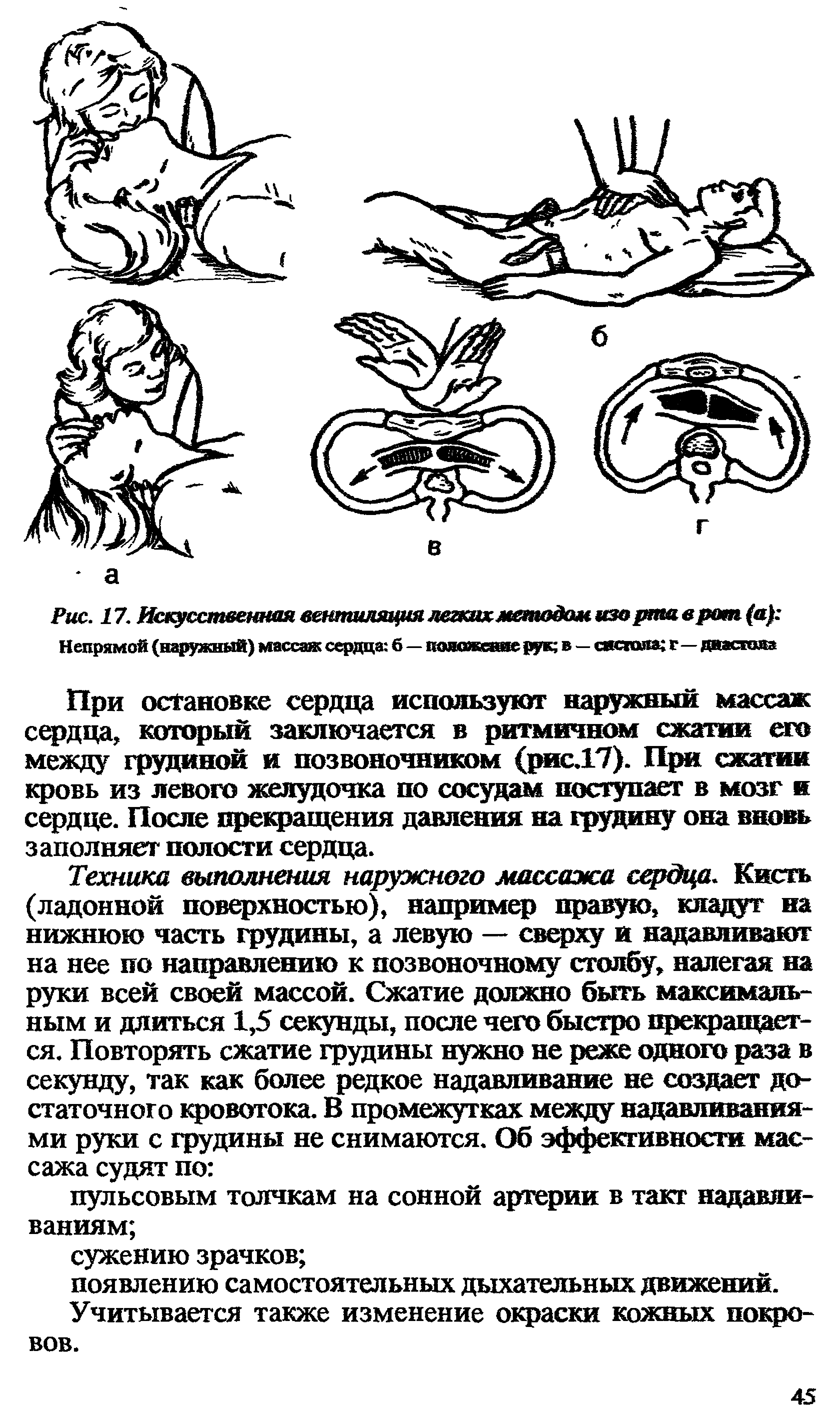 Рис. 17. Искусственная вентиляция дегкихметодом изо рта в рот (а Непрямой (наружный) массаж сердца б—положеяве рук в — систола г—диастола...