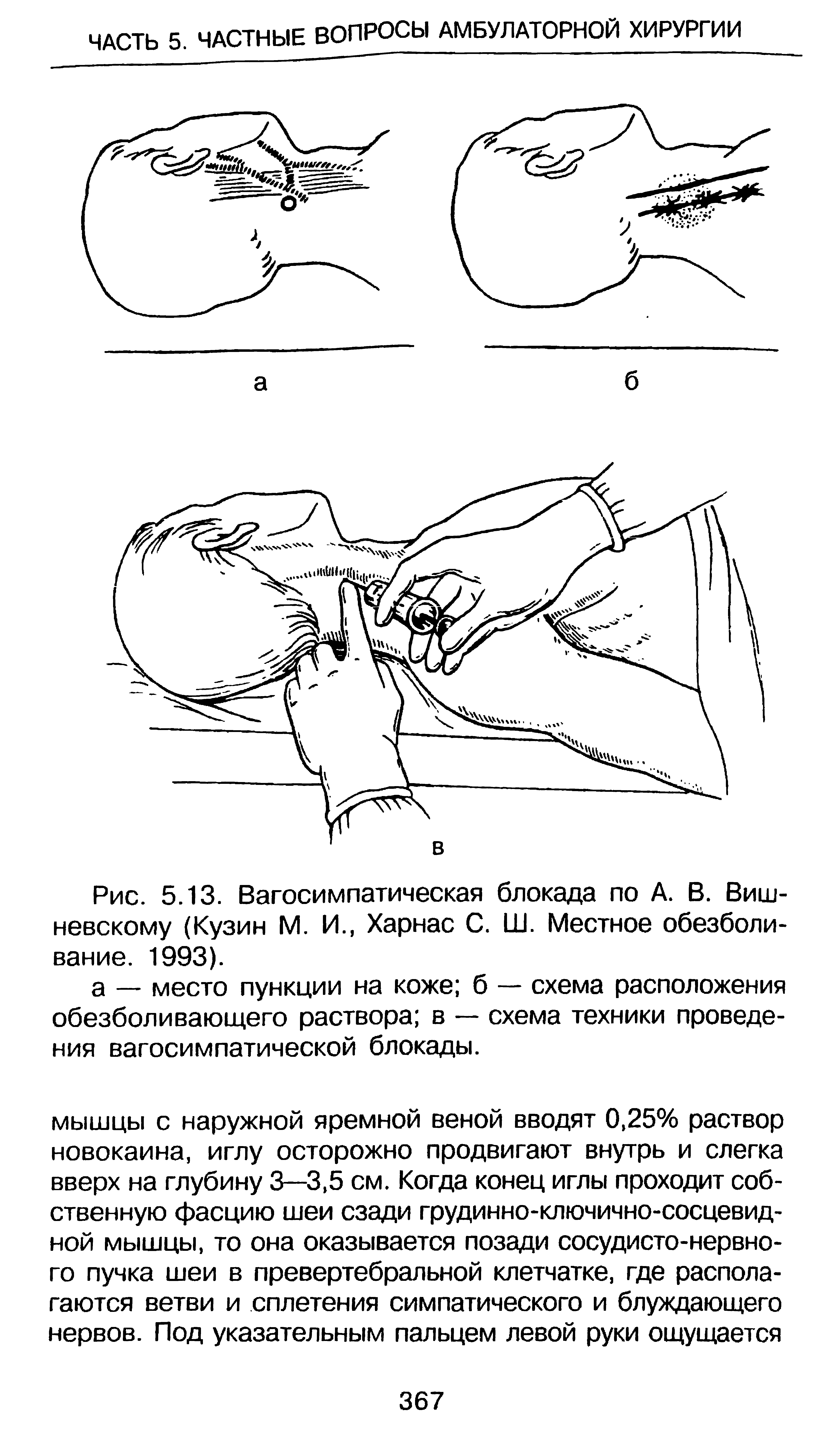 Рис. 5.13. Вагосимпатическая блокада по А. В. Вишневскому (Кузин М. И., Харнас С. Ш. Местное обезболивание. 1993).