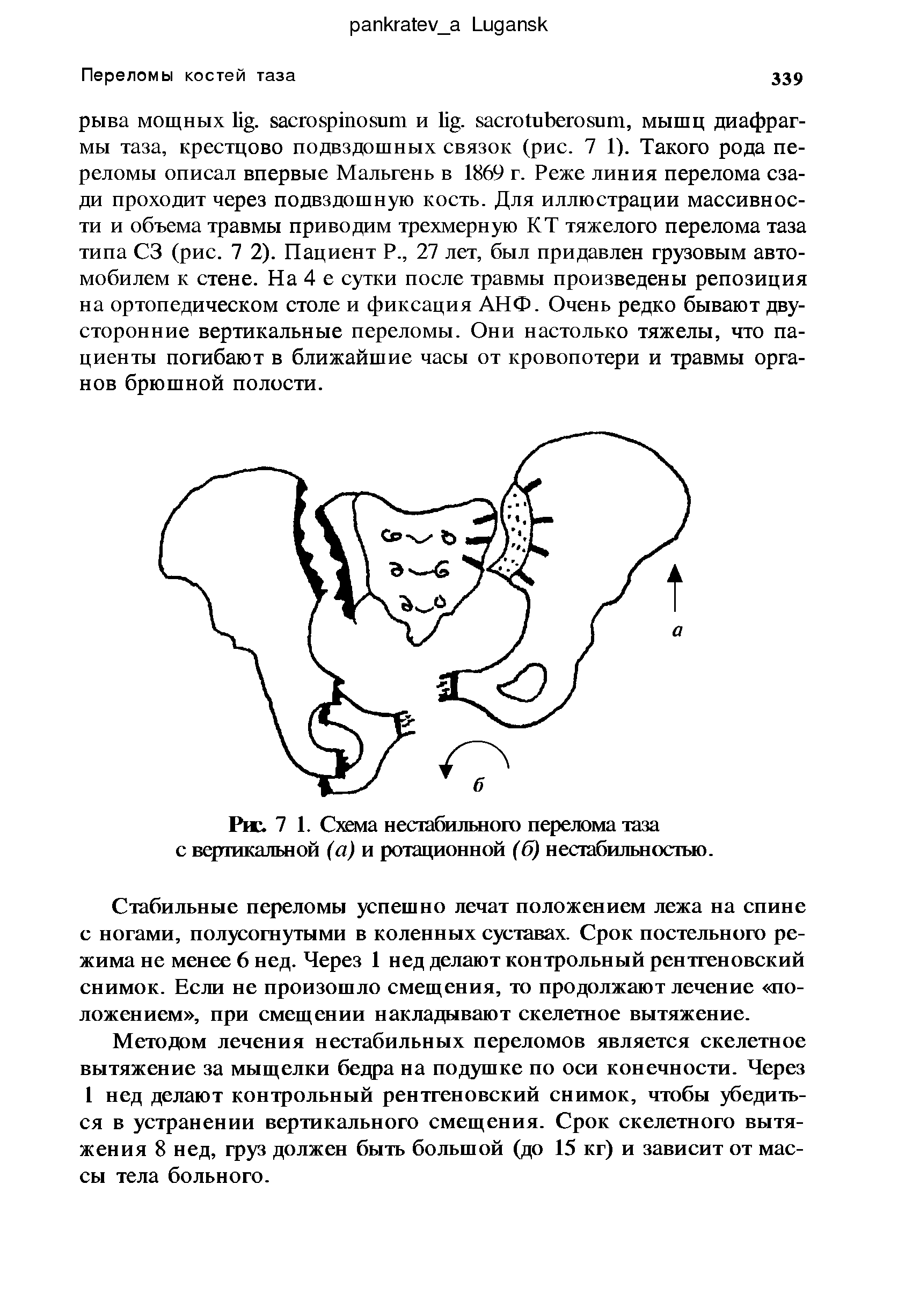 Рис. 7 1. Схема нестабильного перелома таза с вертикальной (а) и ротационной (б) нестабильностью.