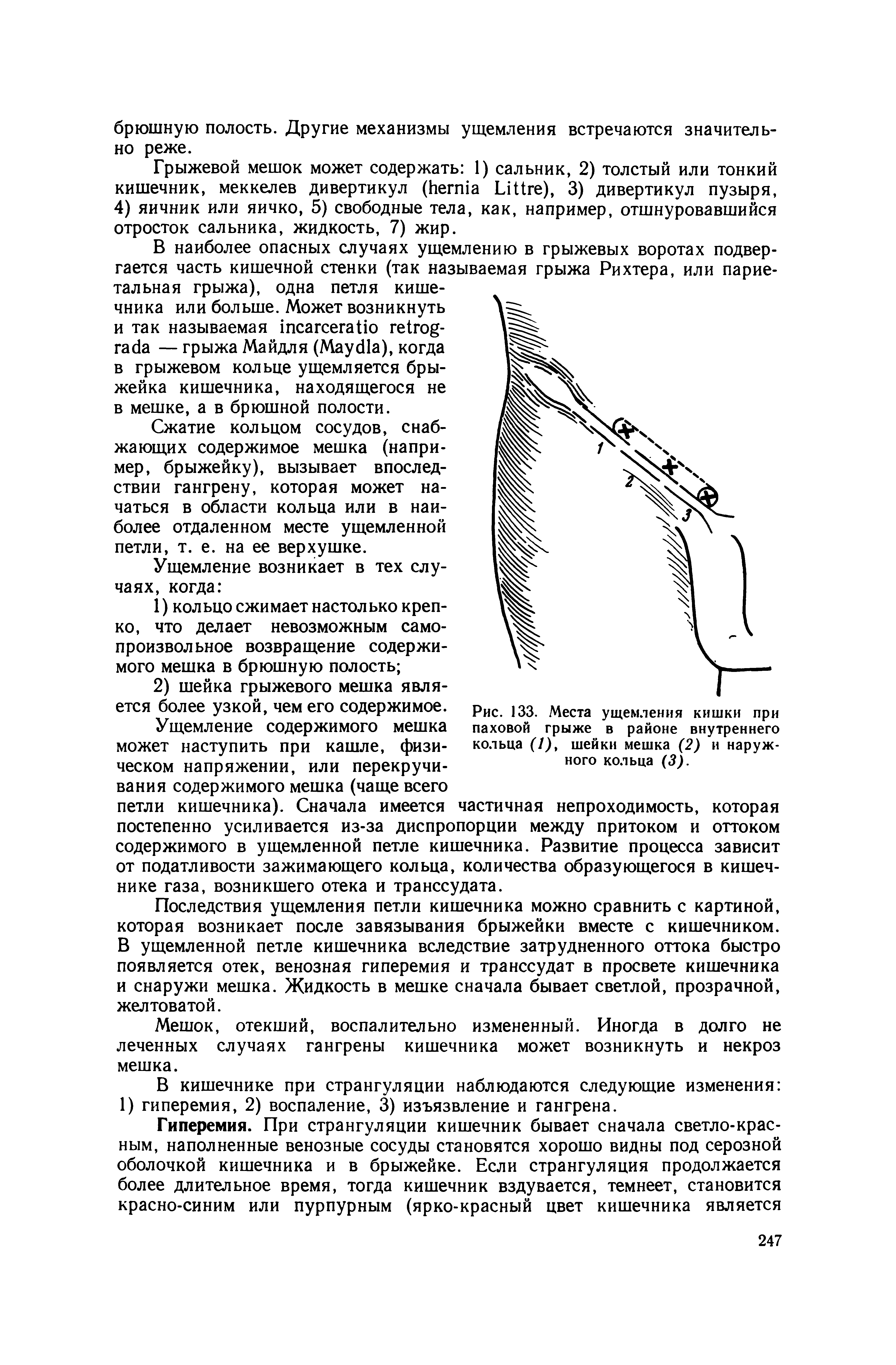 Рис. 133. Места паховой грыже кольца (7), шейки мешка (2) ного кольца (3).