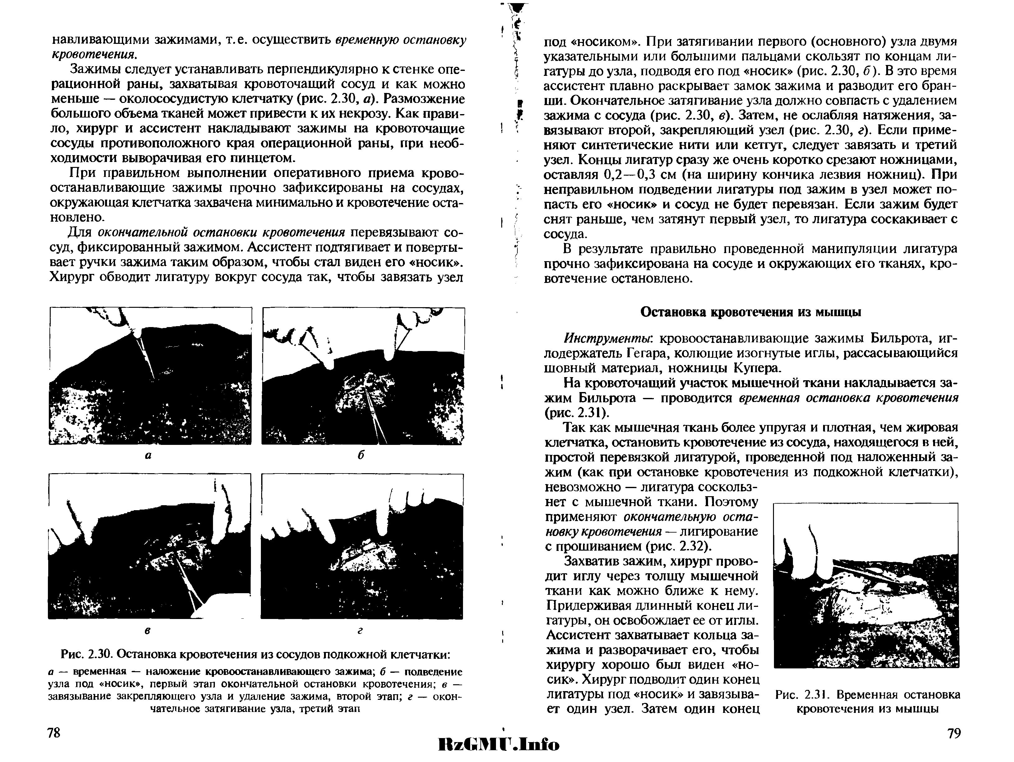 Рис. 2.30. Остановка кровотечения из сосудов подкожной клетчатки а — временная — наложение кровоостанавливающего зажима б — подведение узла под носик , первый этап окончательной остановки кровотечения в — завязывание закрепляющего узла и удаление зажима, второй этап г — окончательное затягивание узла, третий этап...