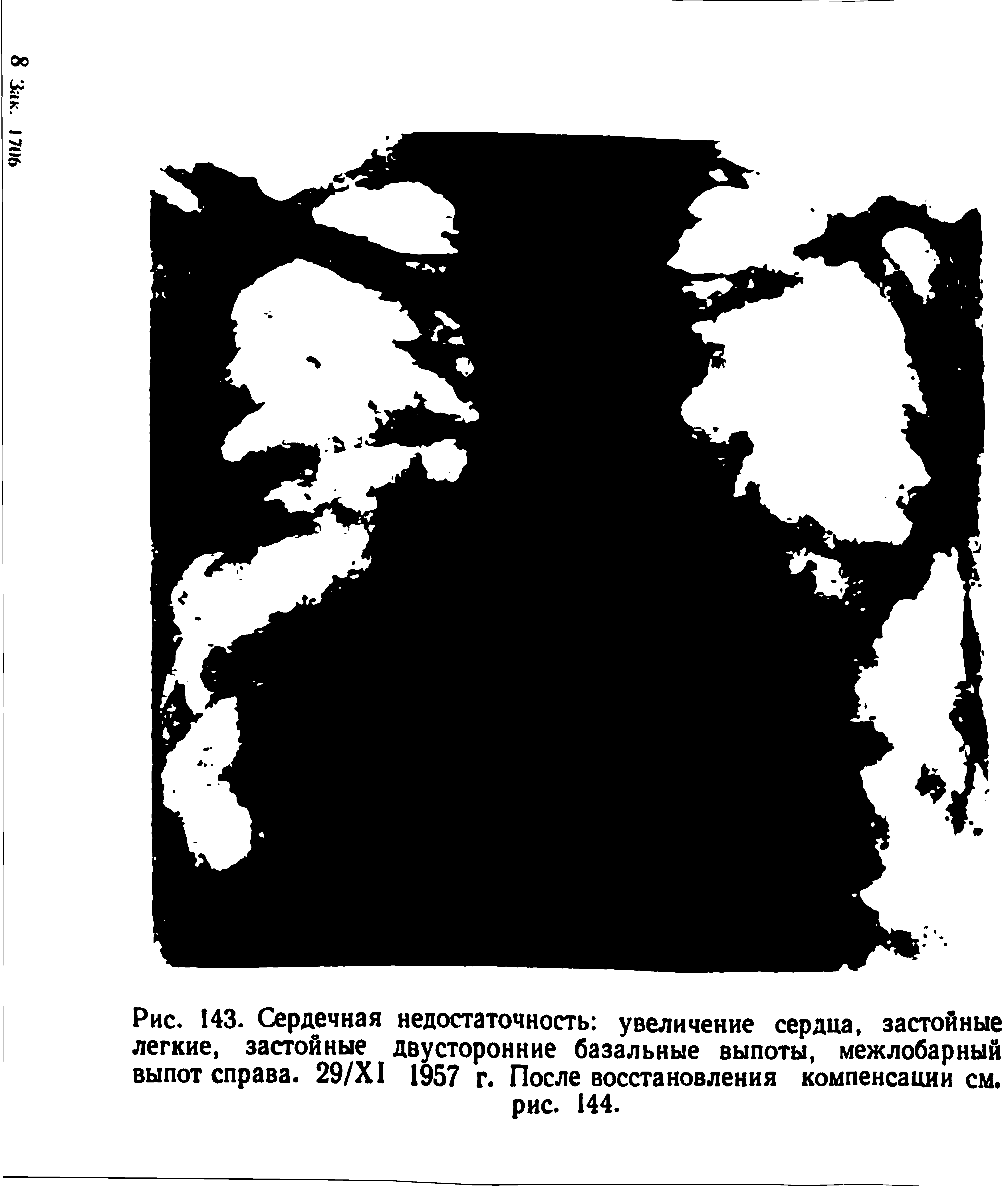 Рис. 143. Сердечная недостаточность увеличение сердца, застойные легкие, застойные двусторонние базальные выпоты, межлобарный выпот справа. 29/Х1 1957 г. После восстановления компенсации см. рис. 144.