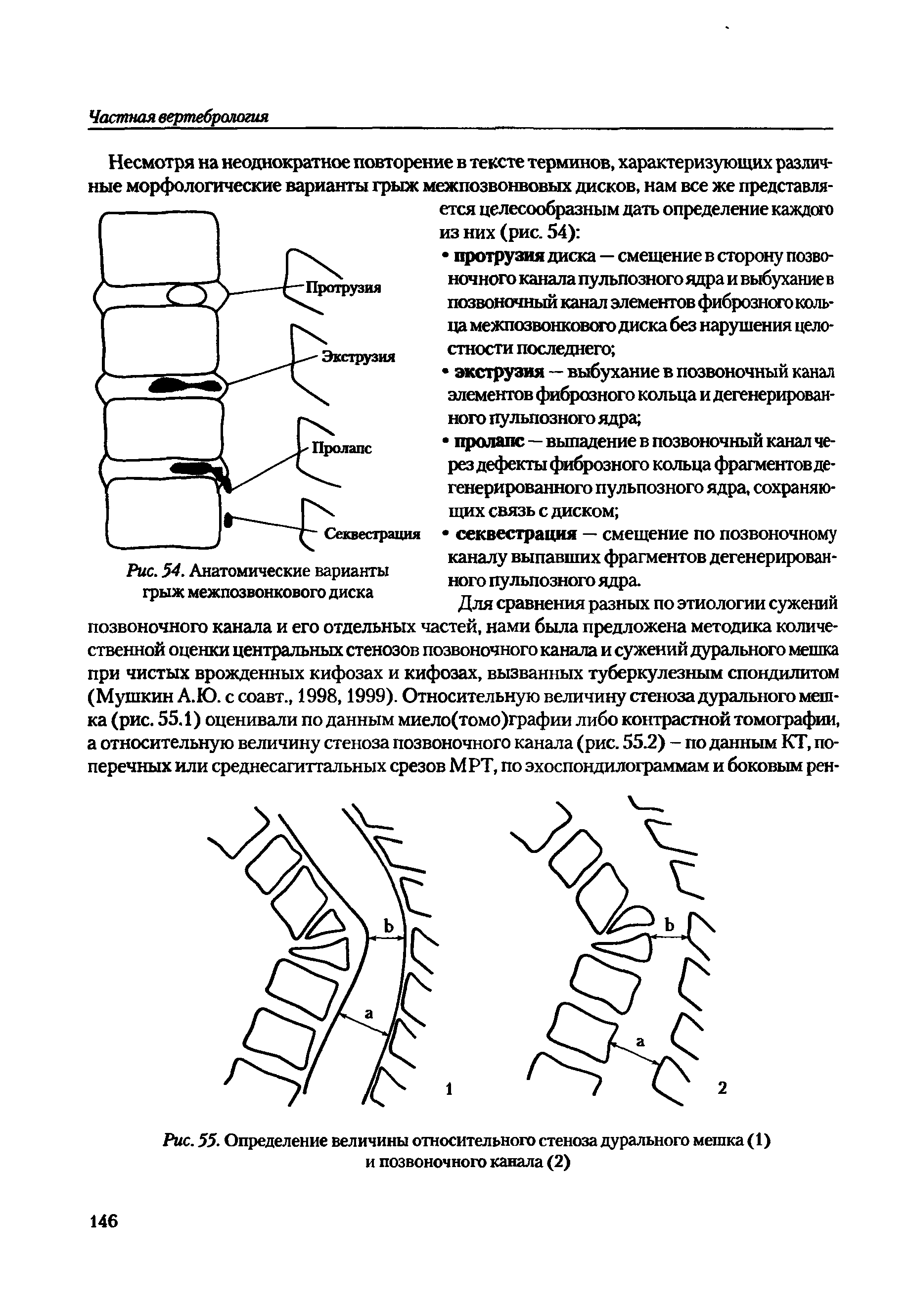 Рис. 55. Определение величины относительного стеноза дурального мешка (1) и позвоночного канала (2)...