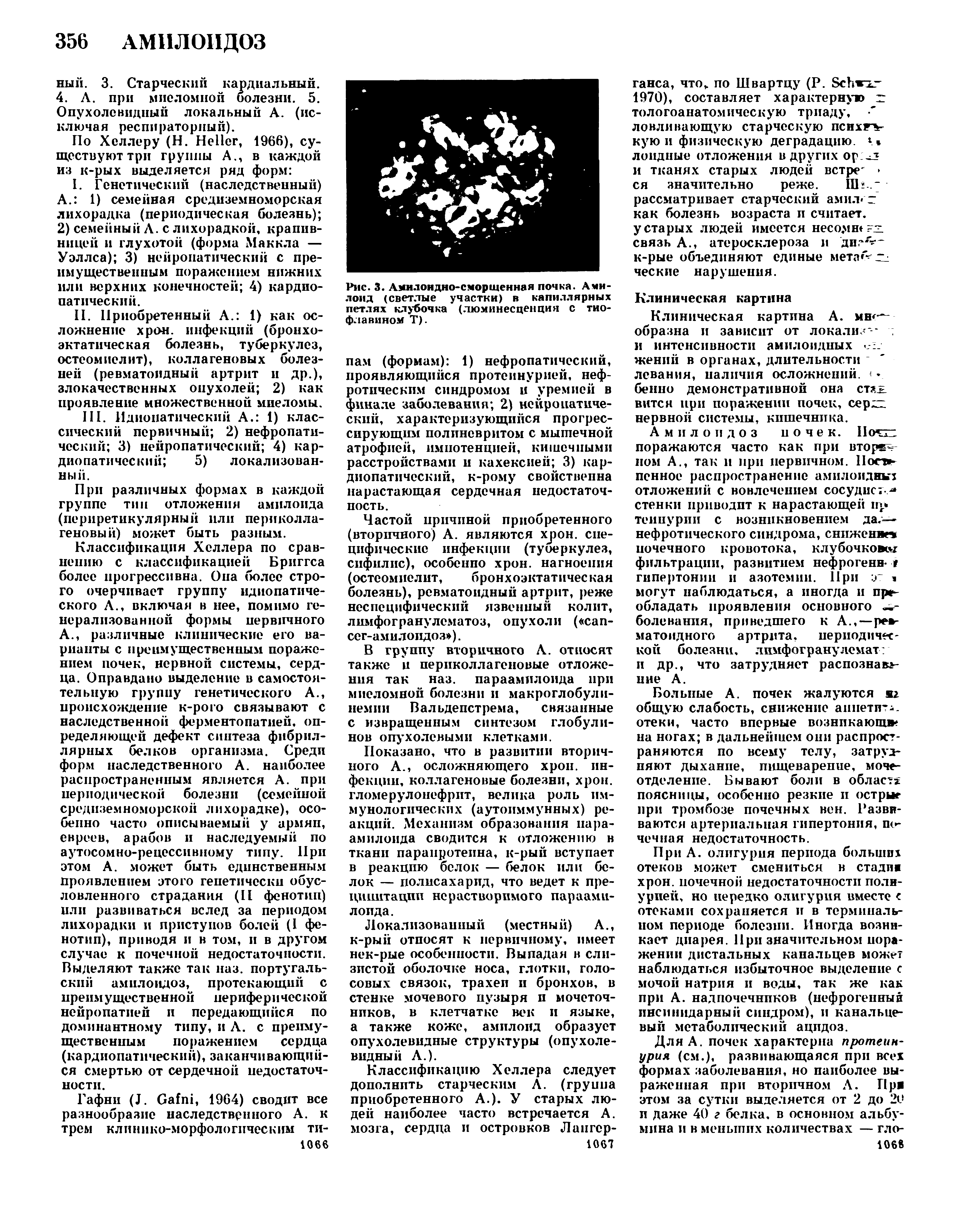 Рис. 3. Амилоидно-сморщенная почка. Амилоид (светлые участки) в капиллярных петлях клубочка (люминесценция с тиофлавином Т).