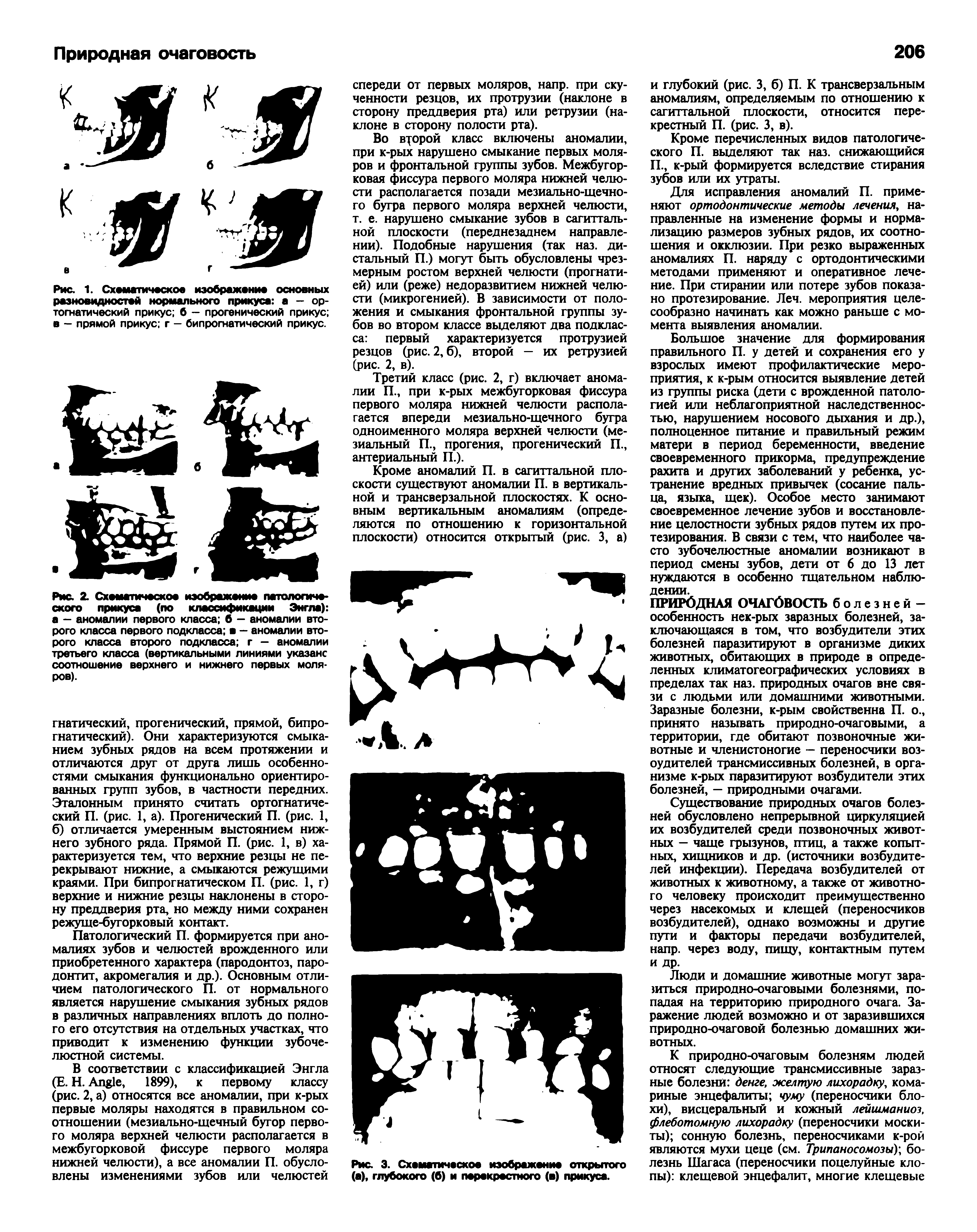 Рис. 1. Схематическое изображение основных разновидностей нормального прикуса а — ортогнатический прикус б — прогенический прикус в — прямой прикус г — бипрогнатический прикус.