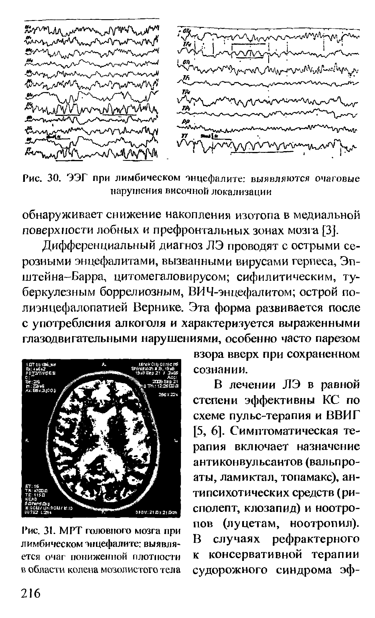 Рис. 30. ЭЭГ при лимбическом энцефалите выявляются очаговые нарушения височной локализации...