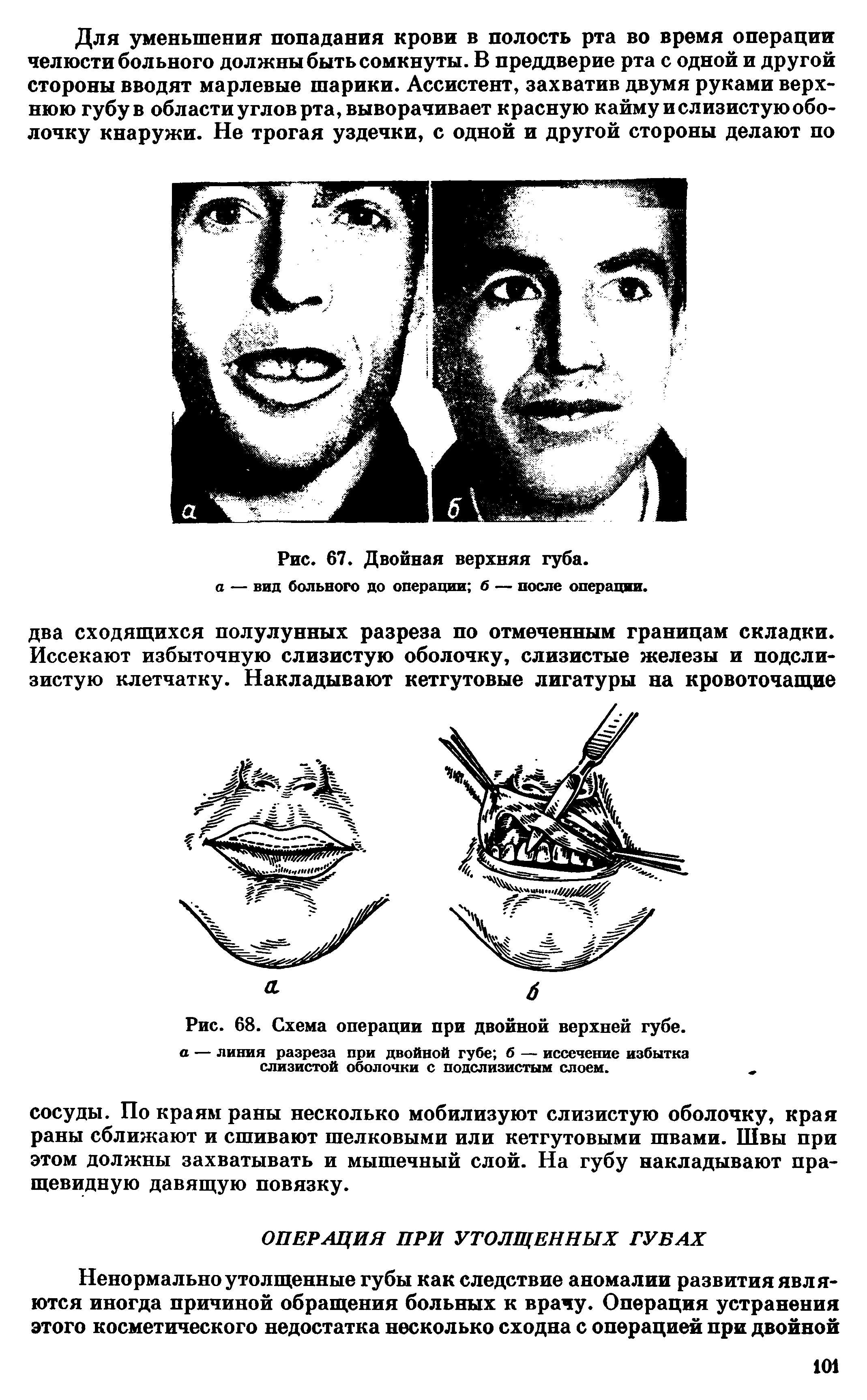 Рис. 68. Схема операции при двойной верхней губе. а — линия разреза при двойной губе б — иссечение избытка слизистой оболочки с подслизистым слоем.