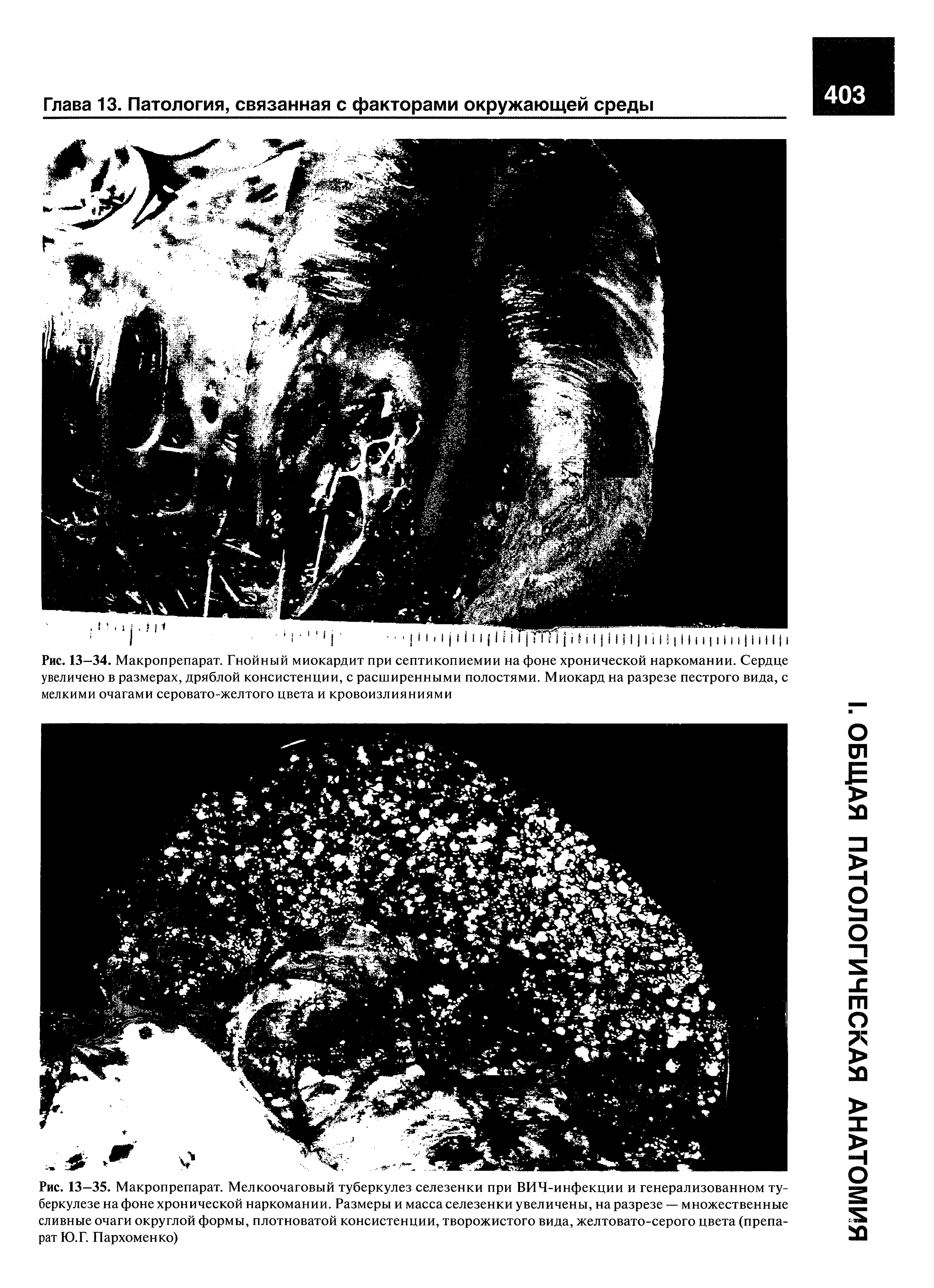 Рис. 13—34. Макропрепарат. Гнойный миокардит при септикопиемии на фоне хронической наркомании. Сердце увеличено в размерах, дряблой консистенции, с расширенными полостями. Миокард на разрезе пестрого вида, с мелкими очагами серовато-желтого цвета и кровоизлияниями...