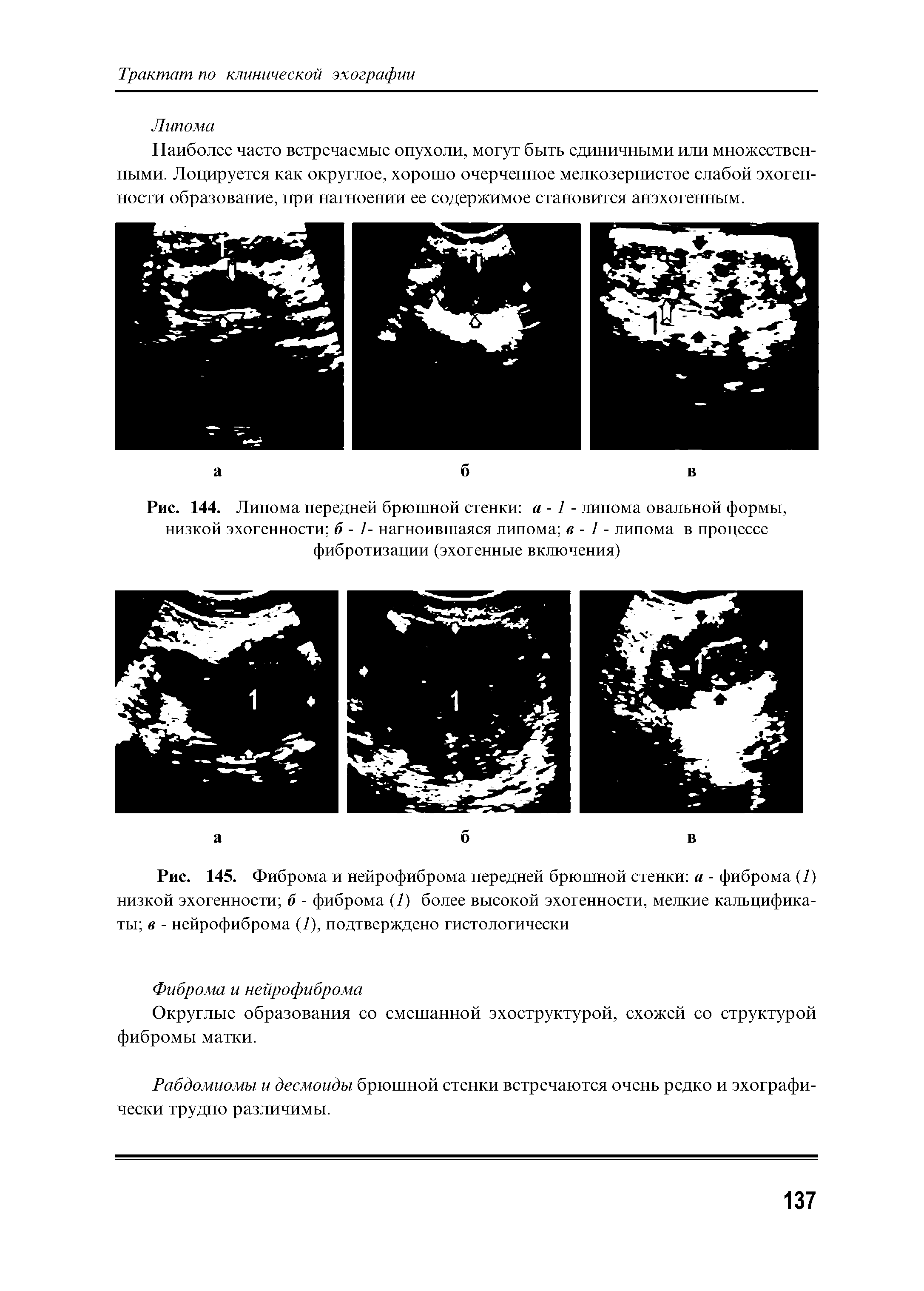 Рис. 144. Липома передней брюшной стенки а -1 - липома овальной формы, низкой эхогенности б -1- нагноившаяся липома в -1 - липома в процессе фибротизации (эхогенные включения)...
