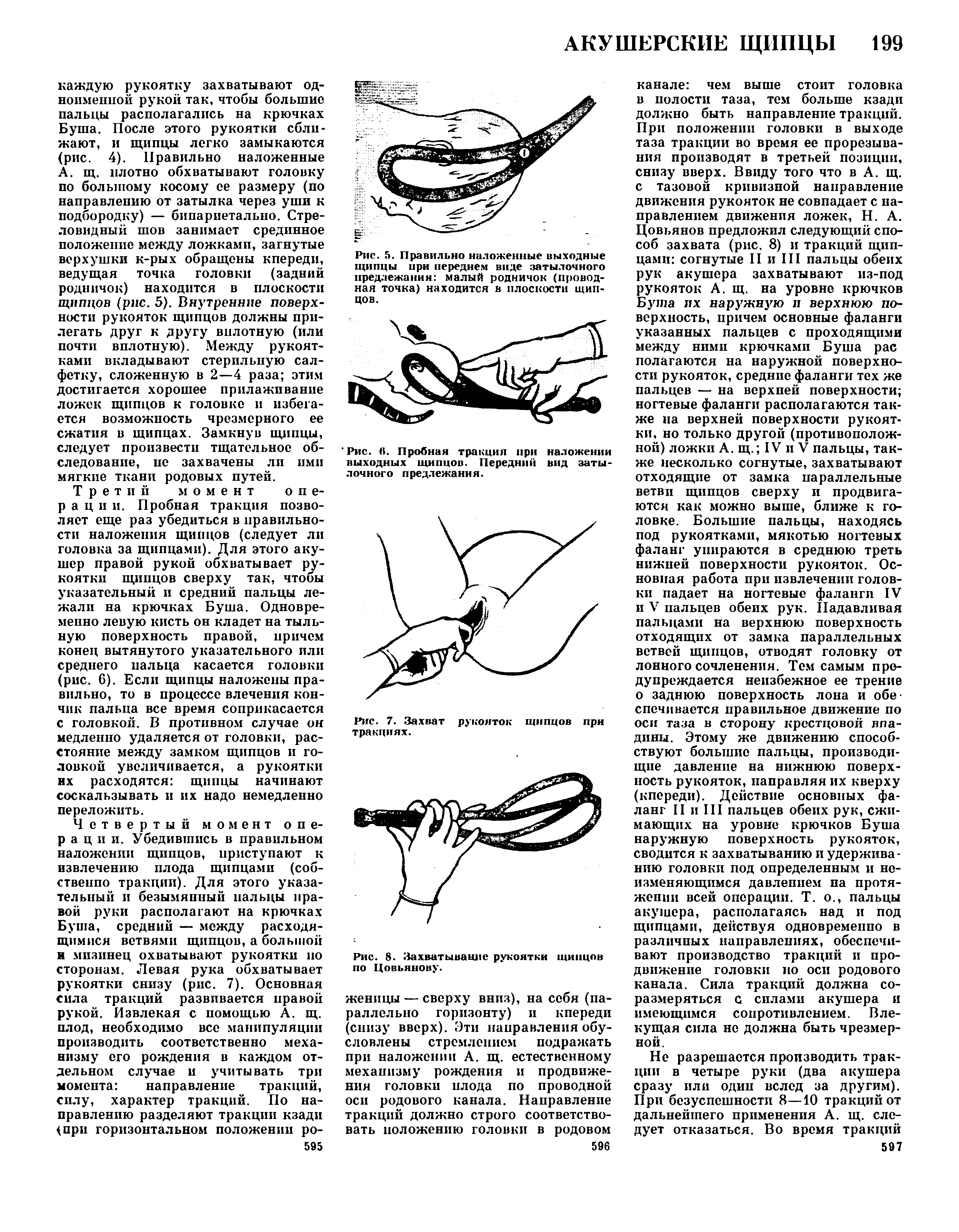 Рис. 6. Пробная тракция при наложении выходных щипцов. Передний вид затылочного предлежания.