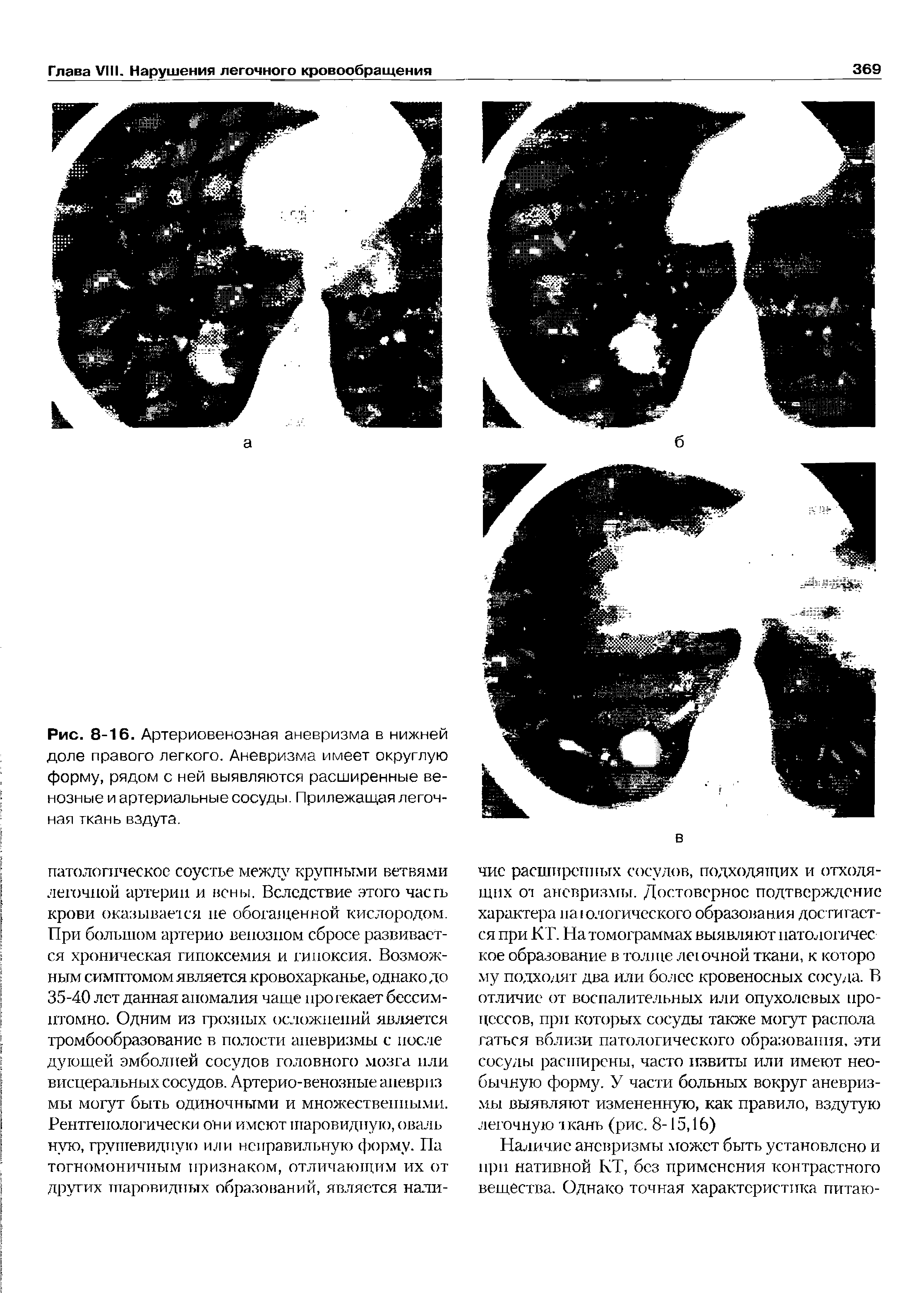 Рис. 8-16. Артериовенозная аневризма в нижней доле правого легкого. Аневризма имеет округлую форму, рядом с ней выявляются расширенные венозные и артериальные сосуды. Прилежащая легочная ткань вздута.