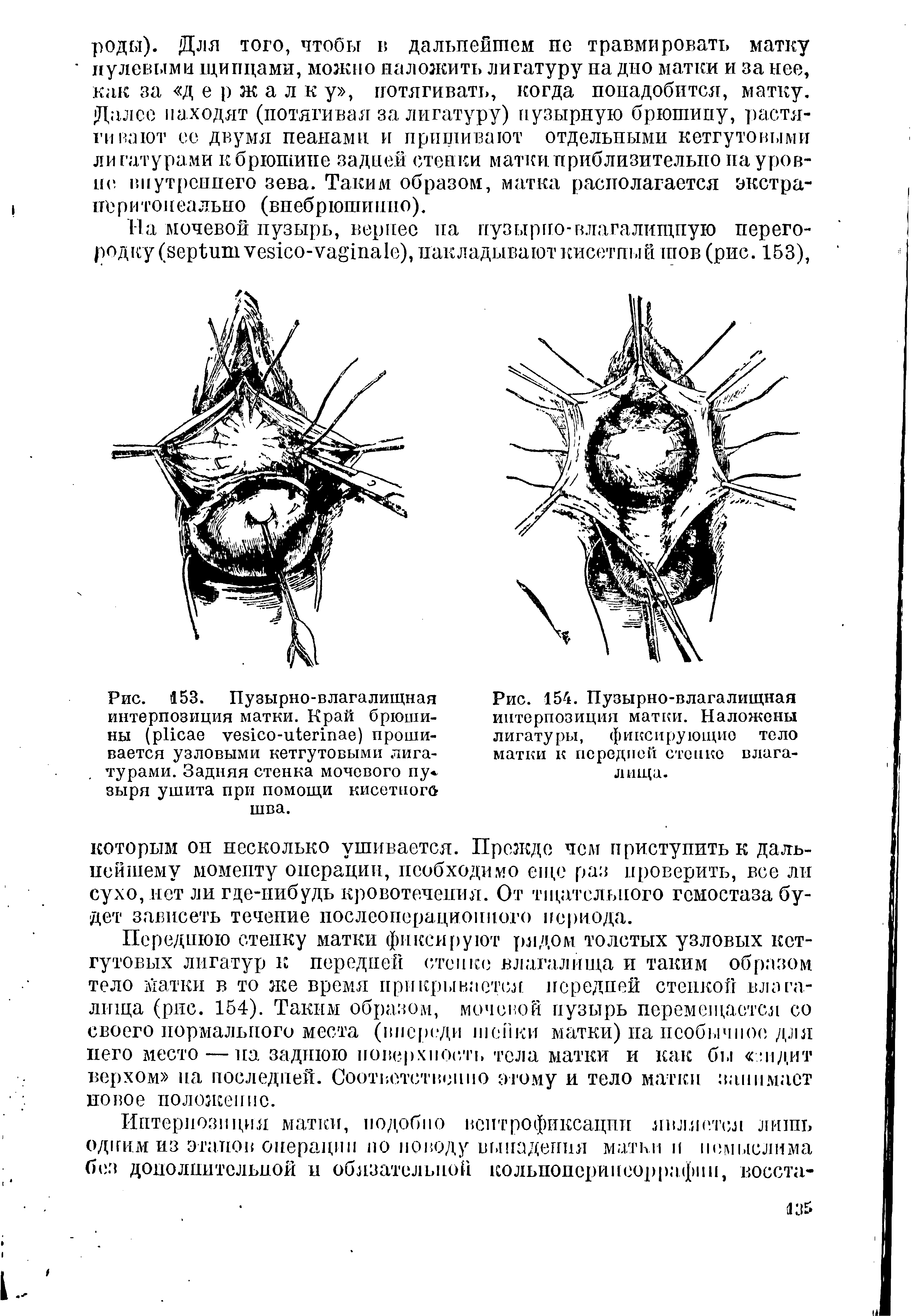 Рис. 153. Пузырно-влагалищная интерпозиция матки. Край брюшины ( - ) прошивается узловыми кетгутовыми лигатурами. Задняя стенка мочевого пу< зыря ушита при помощи кисетного шва.