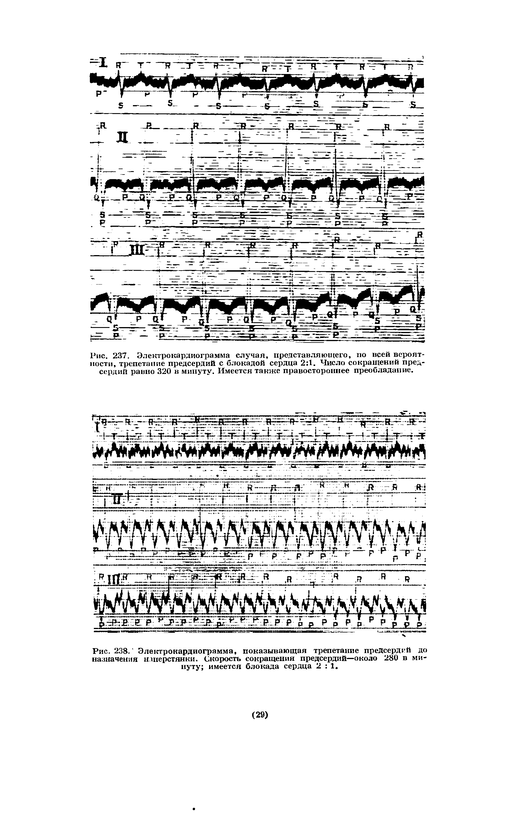 Рис. 238. Электрокардиограмма, показывающая трепетание предсердий до назначения наперстянки. Скорость сокращения предсердий—около 280 в минуту имеется блокада сердца 2 1 ...