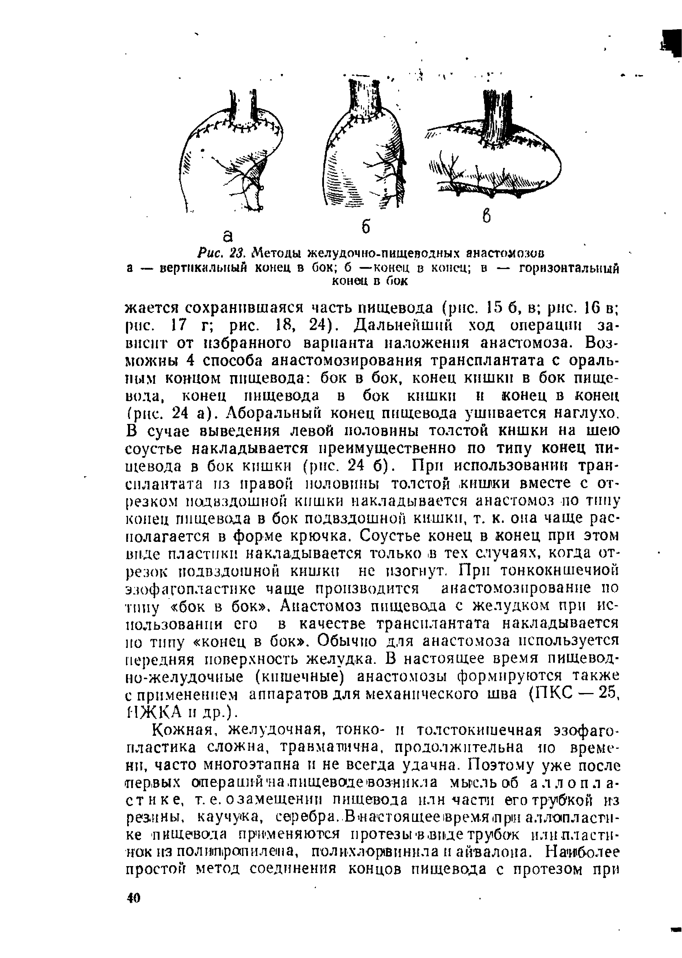 Рис. 23. Методы желудочно-пищеводных анастомозов вертикальный конец в бок б —конец в конец в — горизонтальный конец в бок...