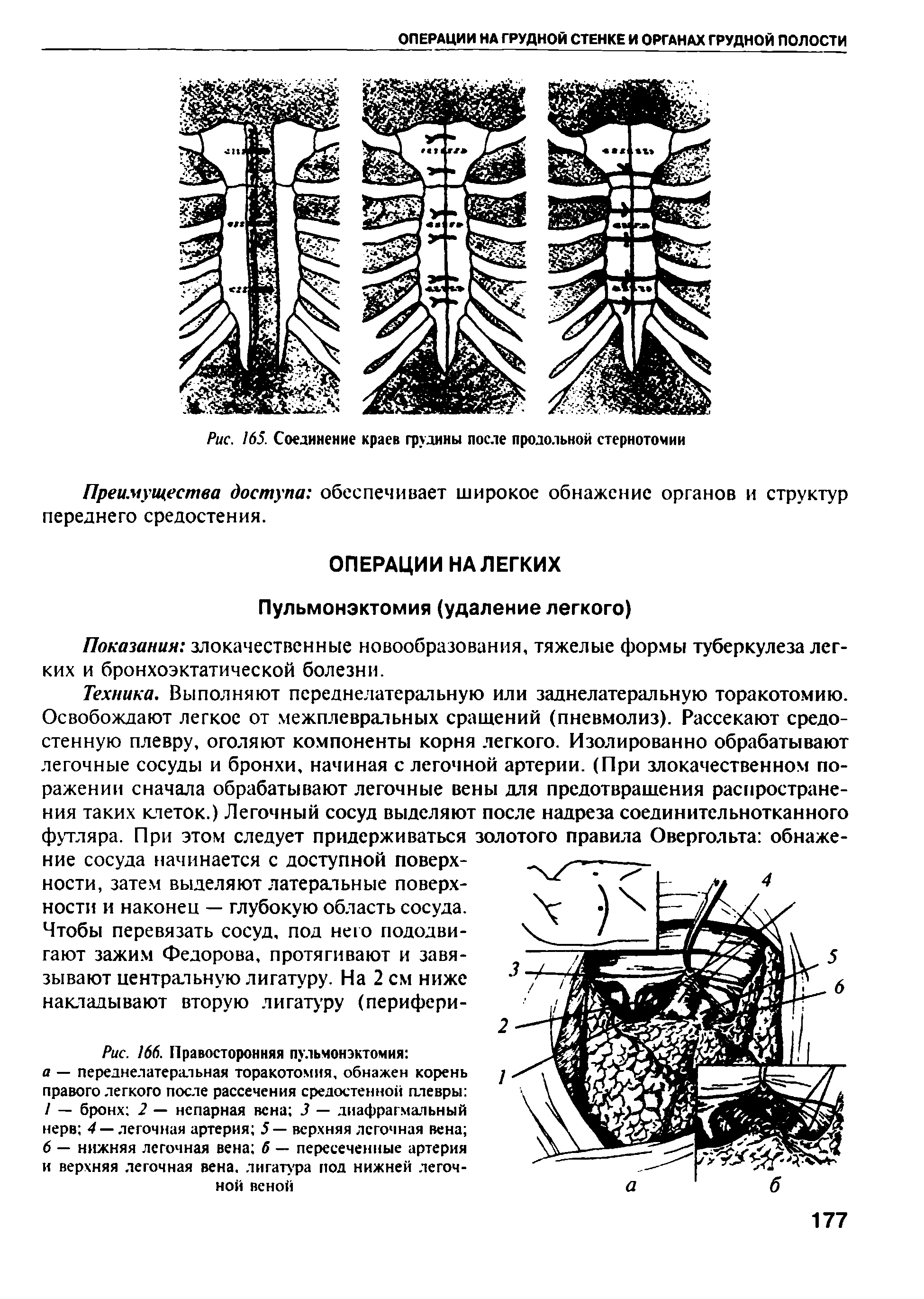 Рис. 166. Правосторонняя пульмонэктомия а — переднелатеральная торакотомия, обнажен корень правого легкого после рассечения средостенной плевры 1 — бронх 2 — непарная вена 3 — диафрагмальный нерв 4 — легочная артерия 5— верхняя легочная вена 6 — нижняя легочная вена б — пересеченные артерия и верхняя легочная вена, лигатура под нижней легочной веной...