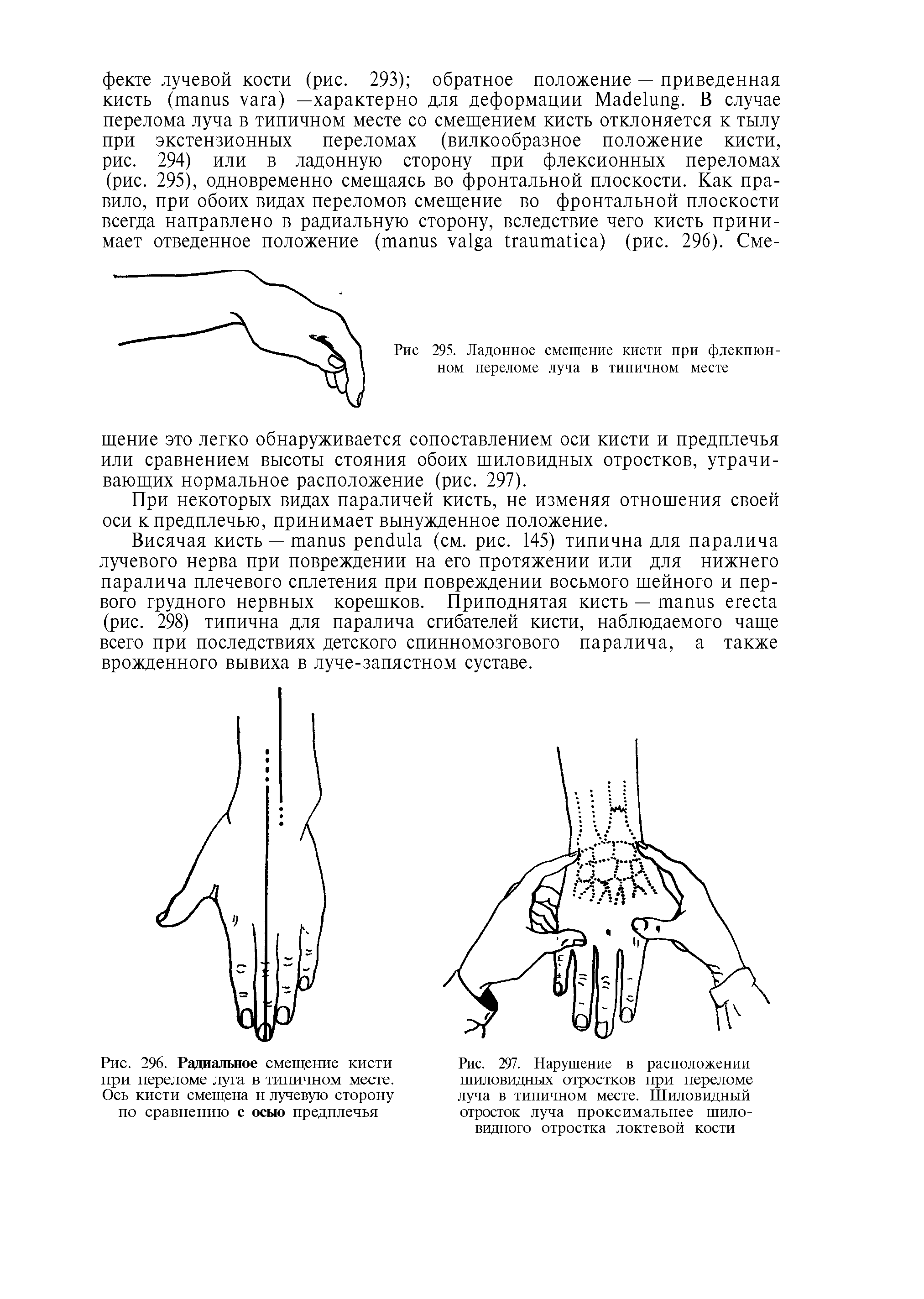 Рис. 296. Радиальное смещение кисти при переломе луга в типичном месте. Ось кисти смещена н лучевую сторону по сравнению с осью предплечья...