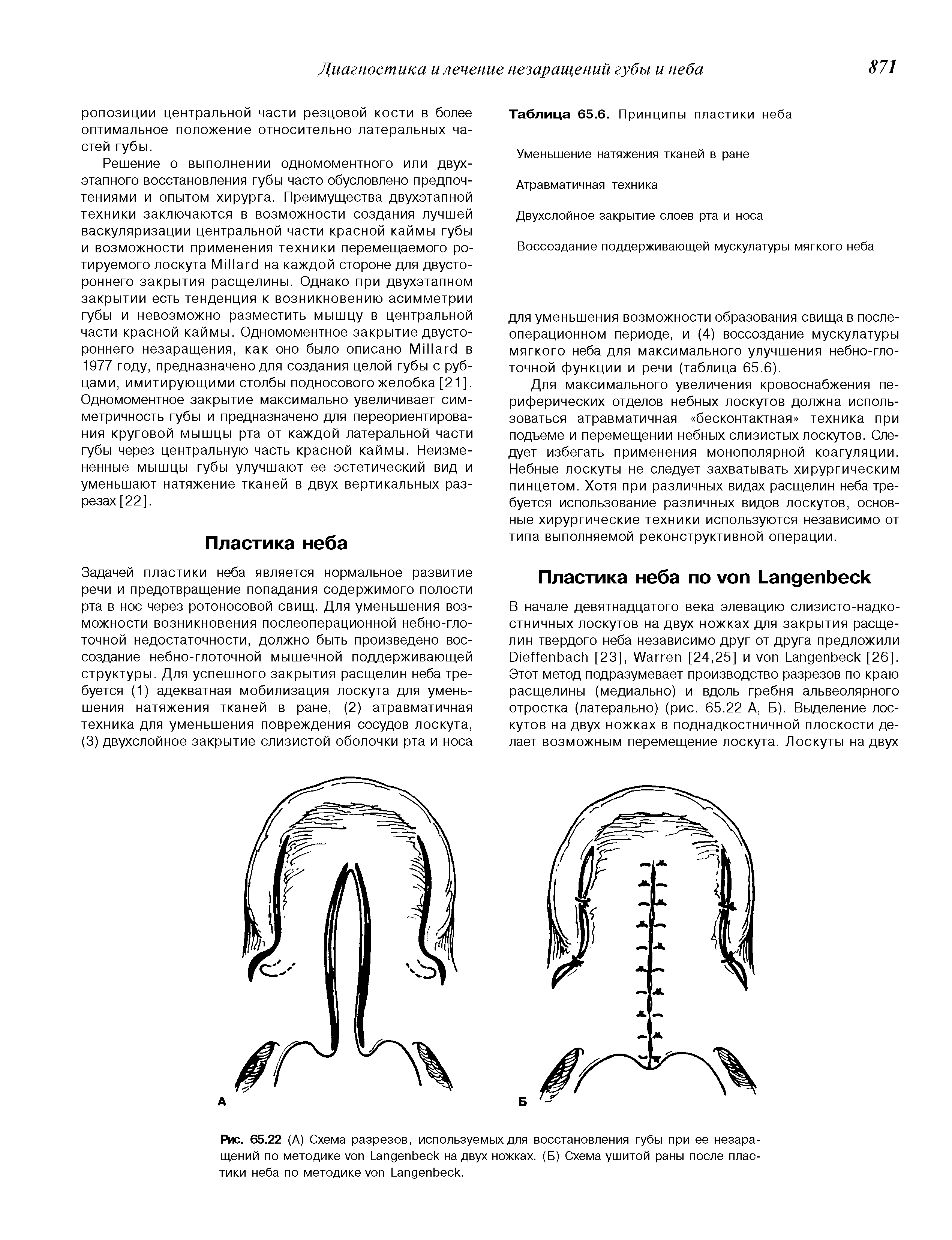 Рис. 65.22 (А) Схема разрезов, используемых для восстановления губы при ее незаращений по методике L на двух ножках. (Б) Схема ушитой раны после пластики неба по методике L .
