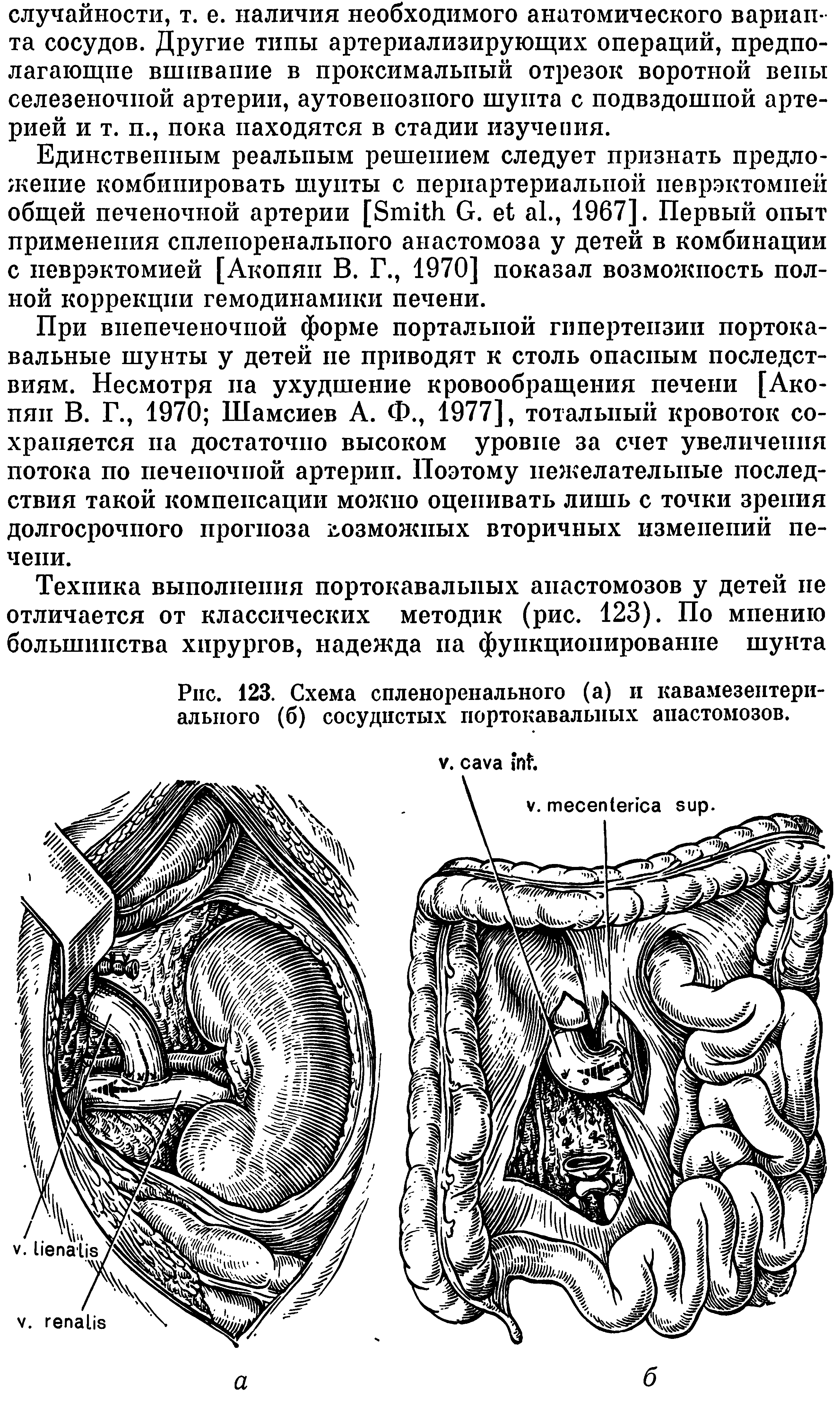 Рис. 123. Схема спленоренального (а) и кавамезентери-ального (б) сосудистых портокавальных анастомозов.