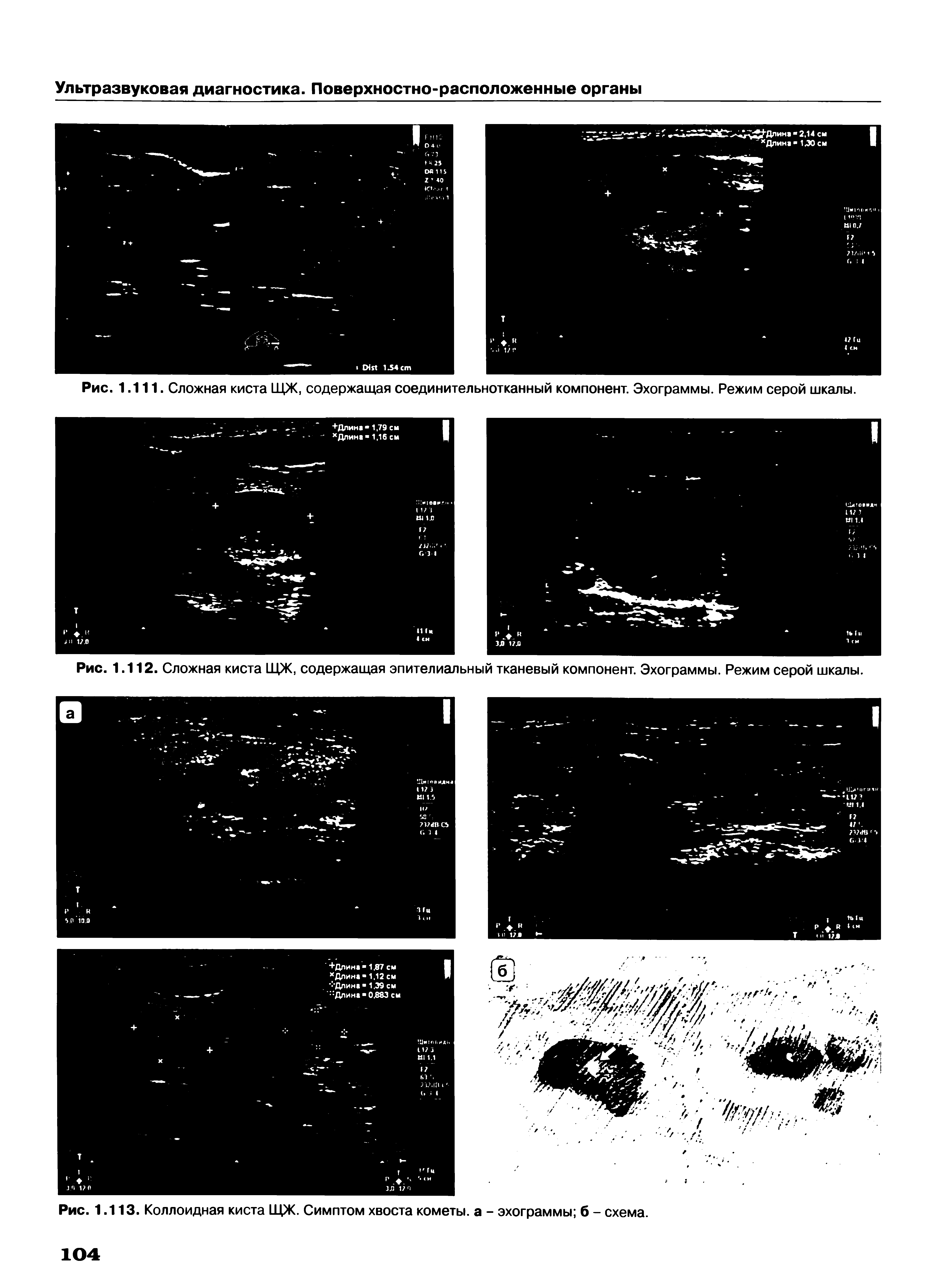 Рис. 1.113. Коллоидная киста ЩЖ. Симптом хвоста кометы, а - эхограммы б - схема.