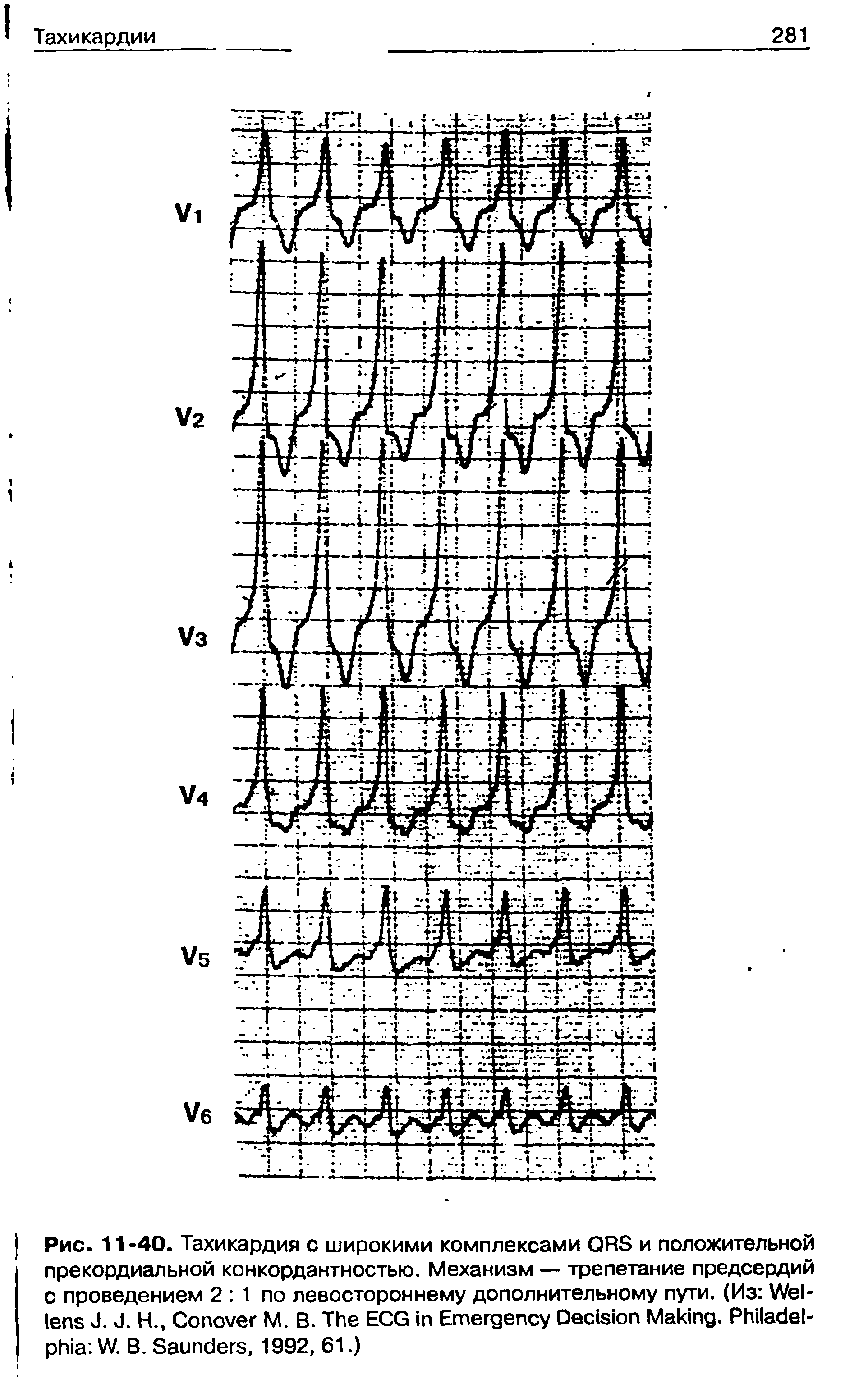 Рис. 11 -40. Тахикардия с широкими комплексами QRS и положительной прекордиальной конкордантностью. Механизм — трепетание предсердий с проведением 2 1 по левостороннему дополнительному пути. (Из W J. J. Н., C М. В. T ECG E D M . P W. B. S , 1992, 61.)...