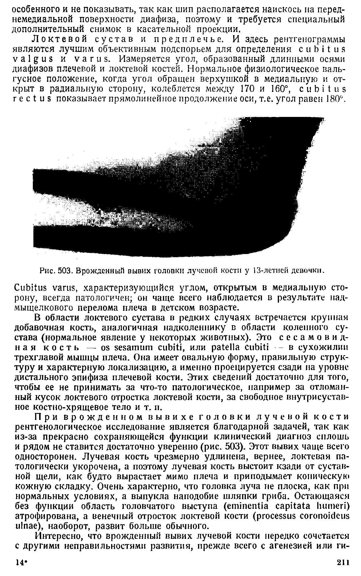 Рис. 503. Врожденный вывих головки лучевой кости у 13-летпсй девочки.