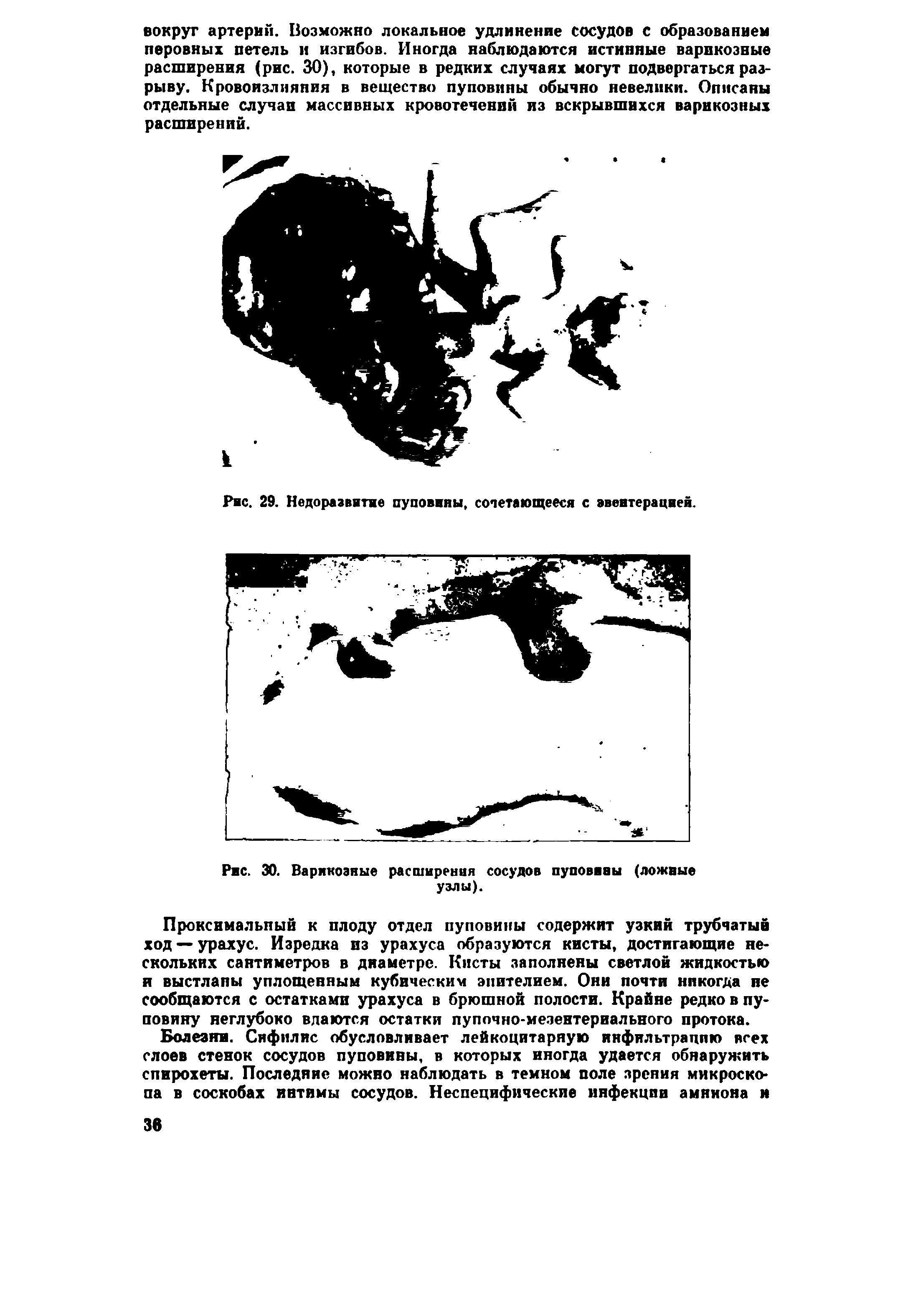 Рис. 30. Варикозные расширения сосудов пуповины (ложные узлы).