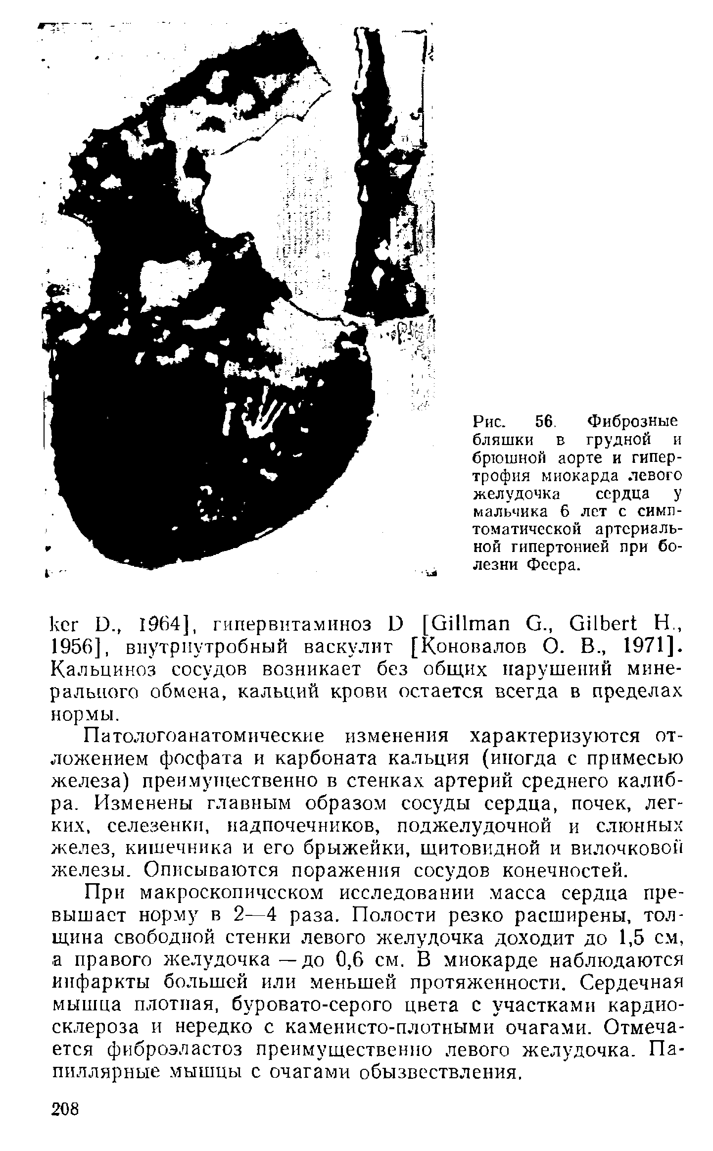 Рис. 56. Фиброзные бляшки в грудной и брюшной аорте и гипертрофия миокарда левого желудочка сердца у мальчика 6 лет с симптоматической артериальной гипертонией при болезни Феера.