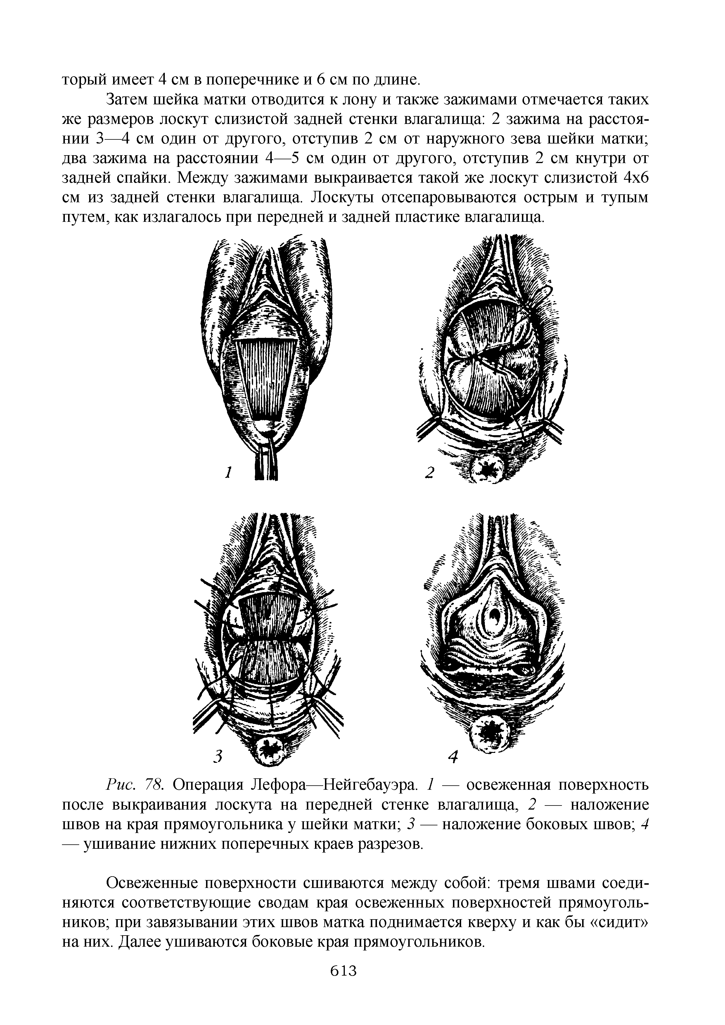 Рис. 78. Операция Лефора—Нейгебауэра. 1 — освеженная поверхность после выкраивания лоскута на передней стенке влагалища, 2 — наложение швов на края прямоугольника у шейки матки 3 — наложение боковых швов 4 — ушивание нижних поперечных краев разрезов.