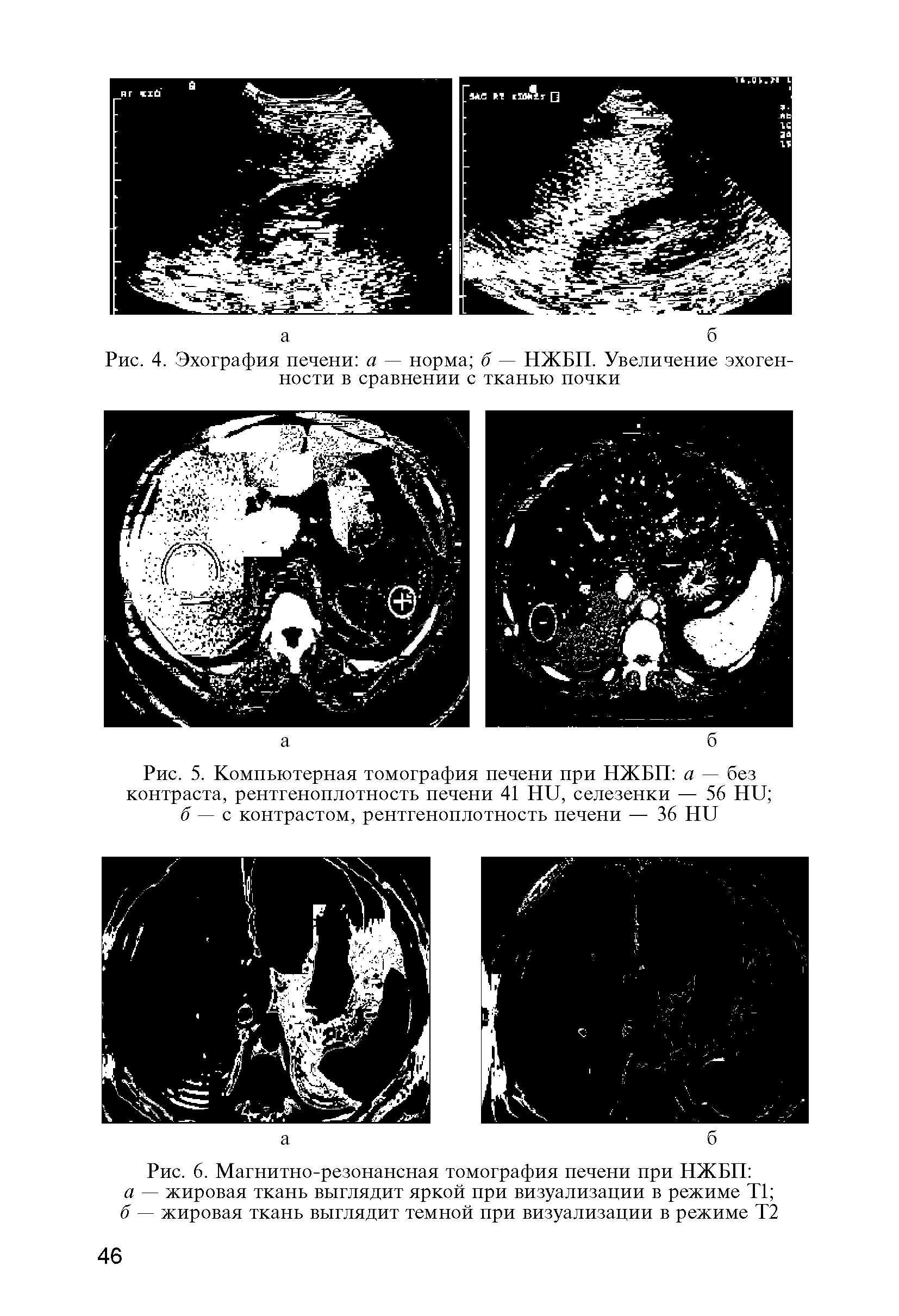 Рис. 4. Эхография печени а — норма б — НЖБП. Увеличение эхогенности в сравнении с тканью почки...