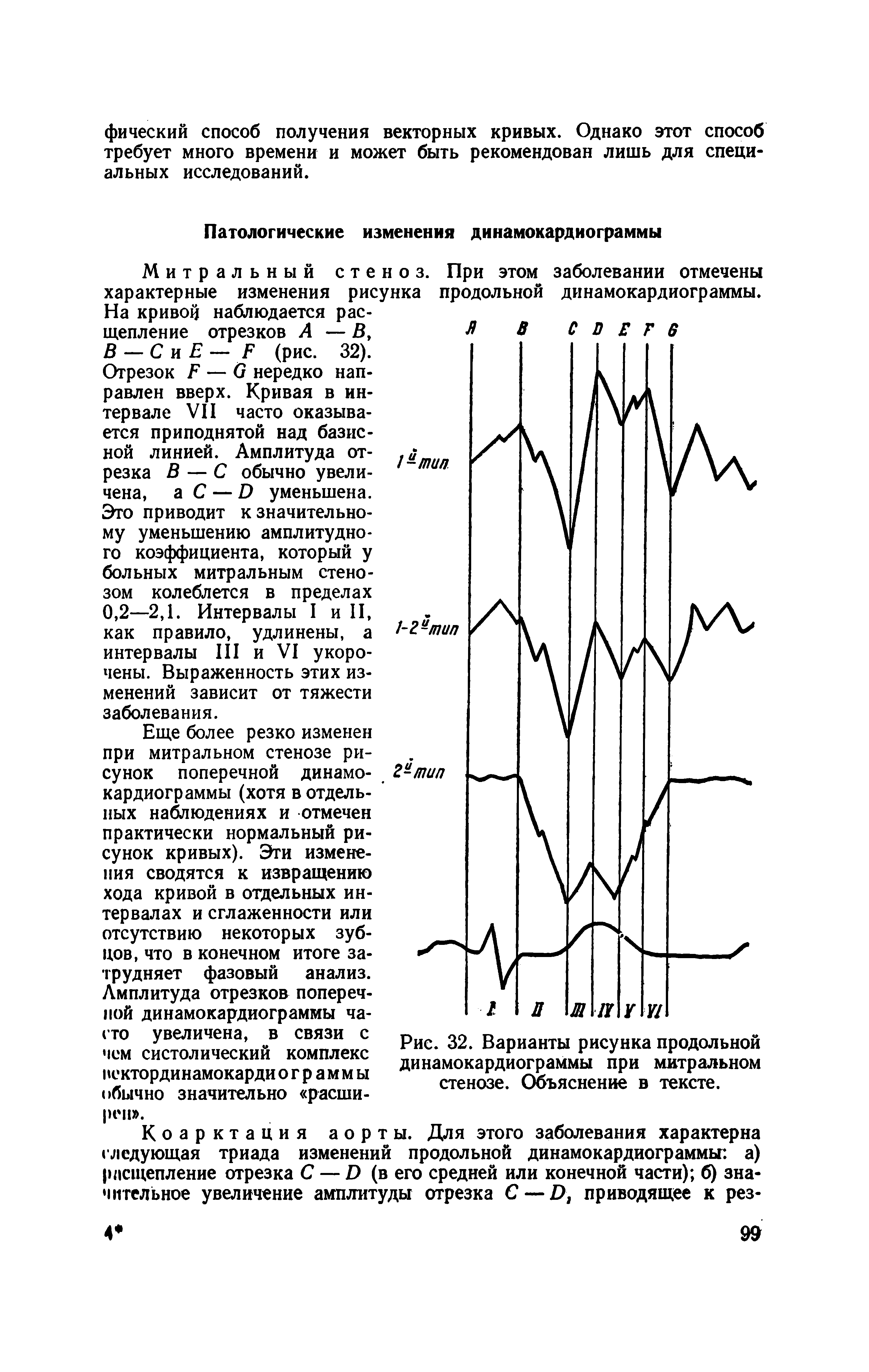 Рис. 32. Варианты рисунка продольной динамокардиограммы при митральном стенозе. Объяснение в тексте.