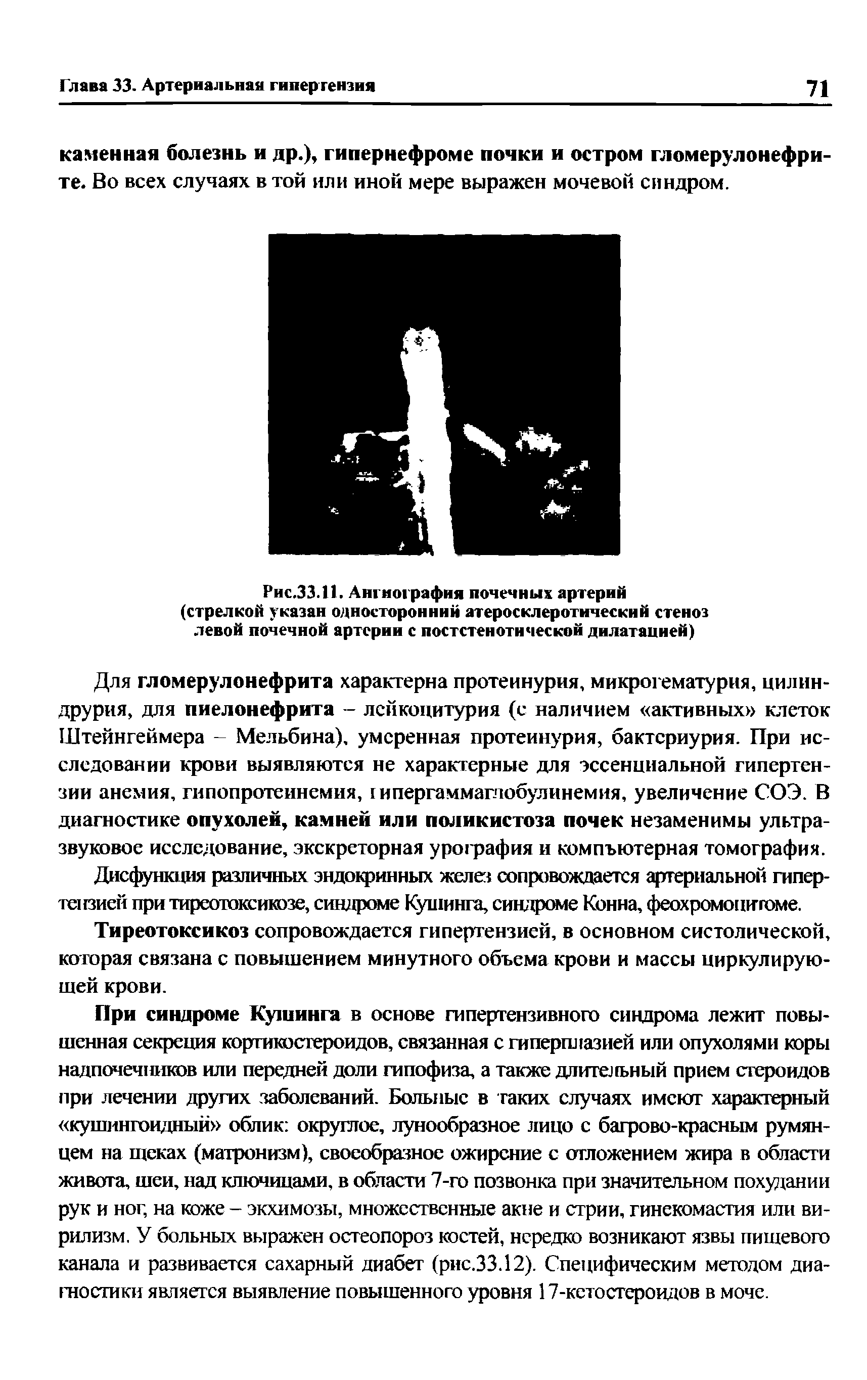 Рис.33.11. Ангиография почечных артерий (стрелкой указан односторонний атеросклеротический стеноз левой почечной артерии с постстенотической дилатацией)...