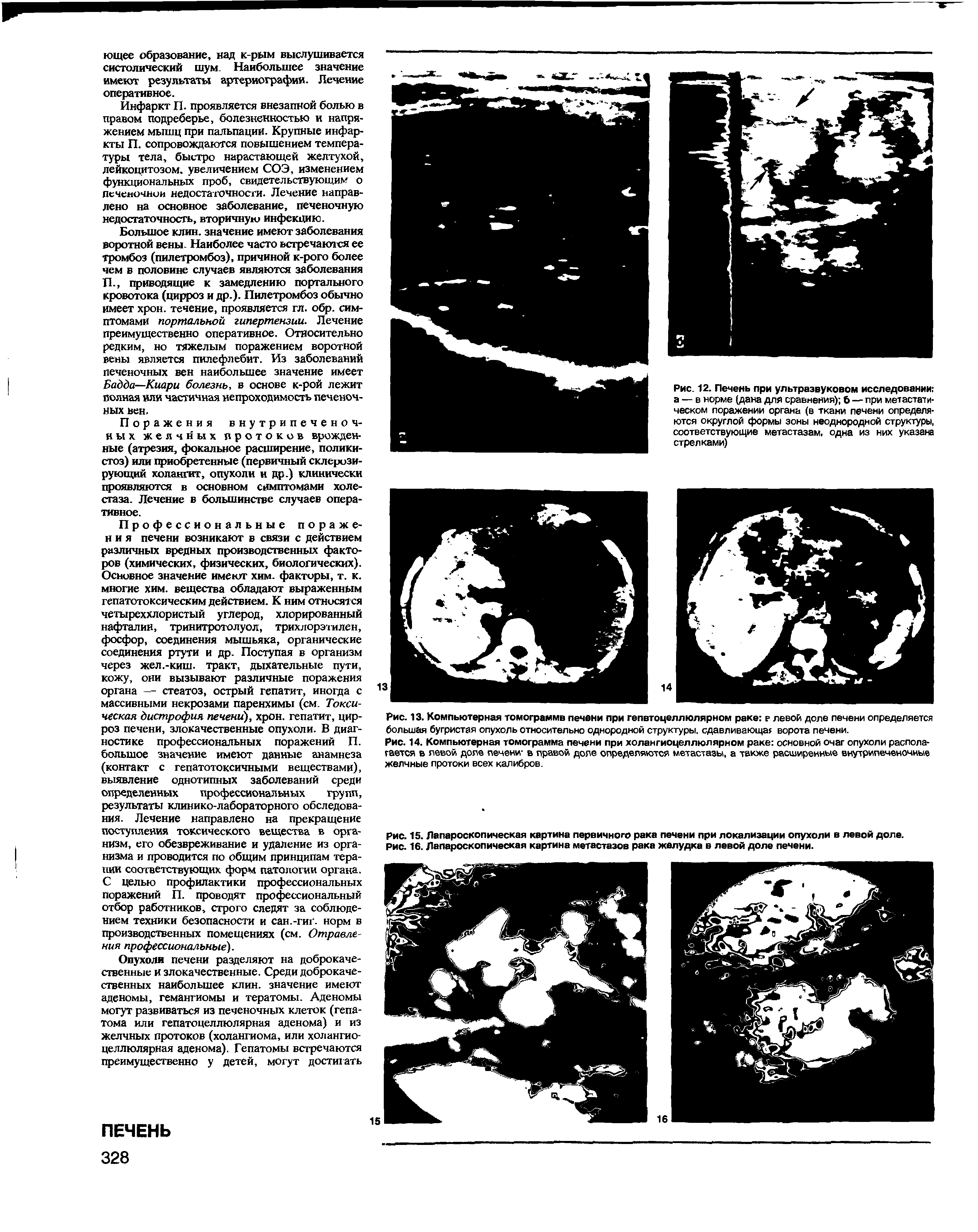 Рис. 14. Компьютерная томограмма печени при холангиоцеллюлярном раке основной очаг опухоли располагается в левой доле печени- в правой доле определяются метастазы, а также расширенные внутрипеченочные желчные протоки всех калибров.