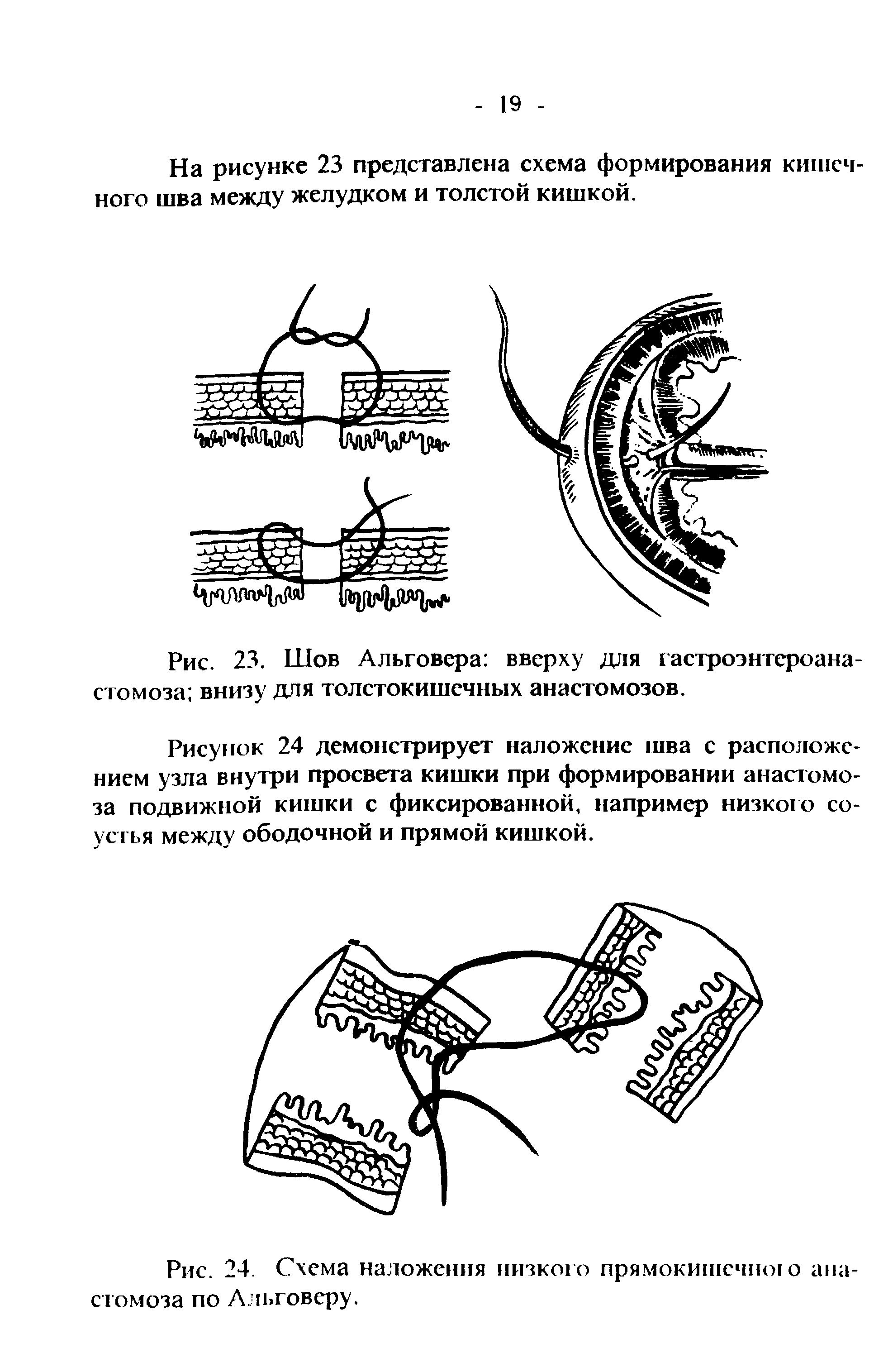 Рис. 24. Схема наложения низкого прямокишечною анастомоза по Альговеру.