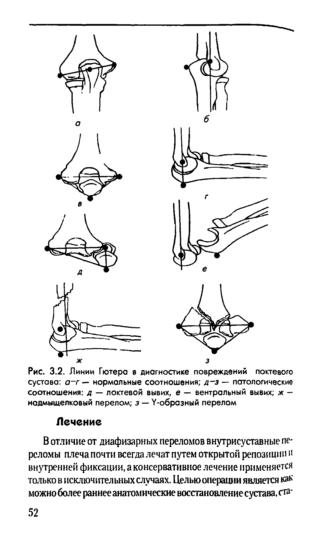 Рис. 3.2. Линии Гютера в диагностике повреждений локтевого сустава а г — нормальные соотношения д-з — патологические соотношения д — локтевой вывих, е — вентральный вывих ж — надмыщелковый перелом з — У-образный перелом...