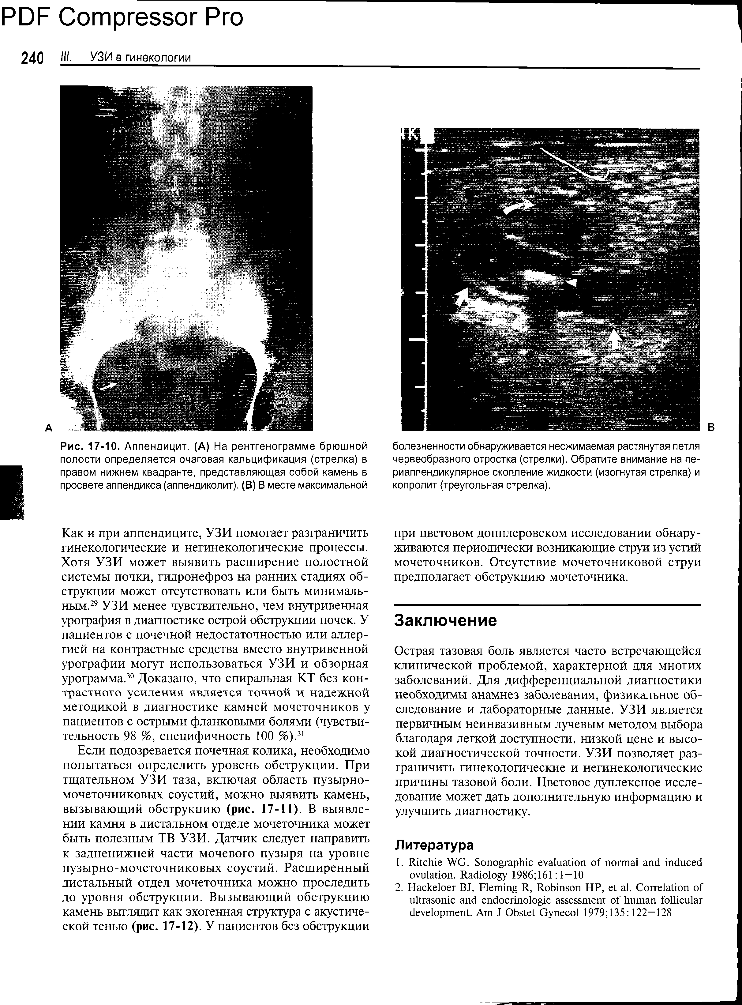 Рис. 17-10. Аппендицит. (А) На рентгенограмме брюшной полости определяется очаговая кальцификация (стрелка) в правом нижнем квадранте, представляющая собой камень в просвете аппендикса (аппендиколит). (В) В месте максимальной...