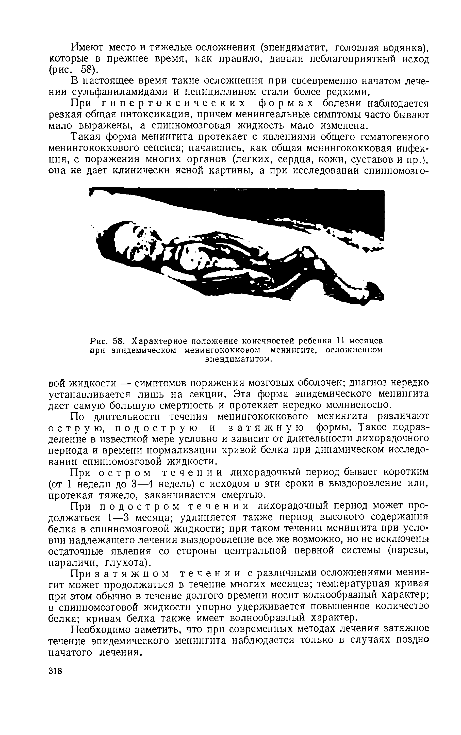 Рис. 58. Характерное положение конечностей ребенка 11 месяцев при эпидемическом менингококковом менингите, осложненном эпендиматитом.