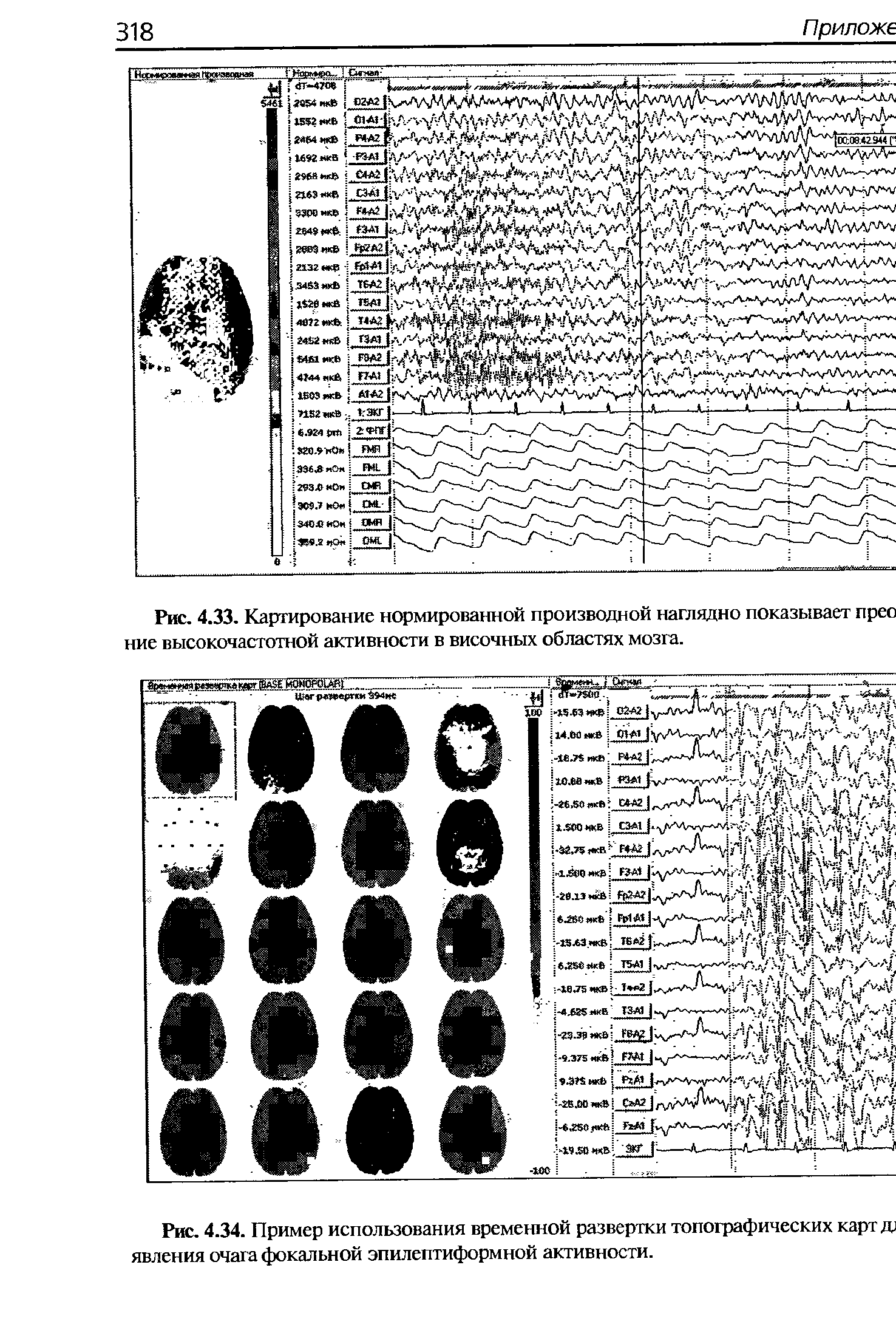 Рис. 4.34. Пример использования временной развертки топографических карт д) явления очага фокальной эпилептиформной активности.
