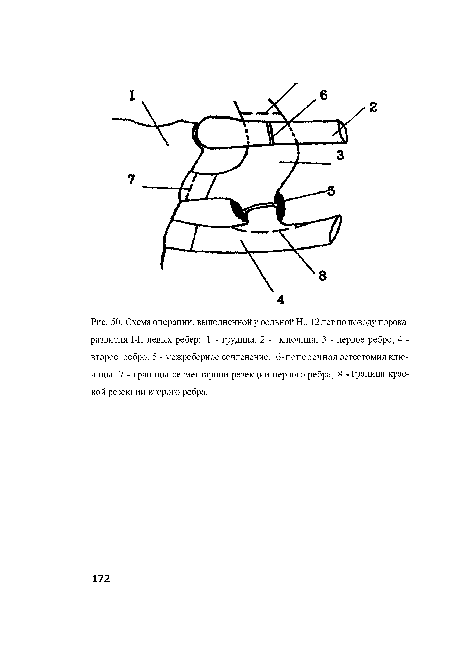 Рис. 50. Схема операции, выполненной у больной Н., 12 лет по поводу порока развития 1-П левых ребер 1 - грудина, 2 - ключица, 3 - первое ребро, 4 -второе ребро, 5 - межреберное сочленение, 6-поперечная остеотомия ключицы, 7 - границы сегментарной резекции первого ребра, 8 -Граница краевой резекции второго ребра.