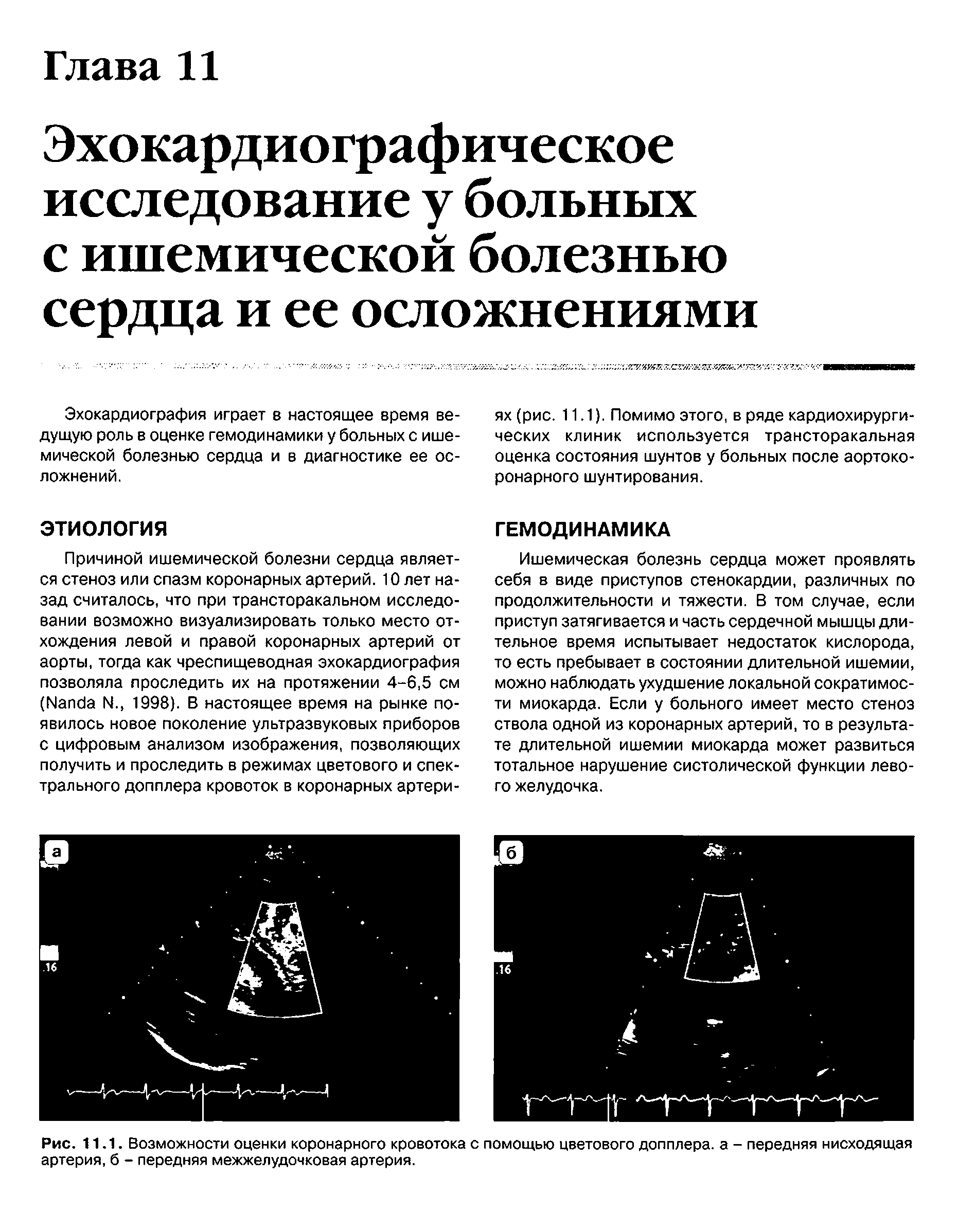 Рис. 11.1. Возможности оценки коронарного кровотока с помощью цветового допплера, а - передняя нисходящая артерия, б - передняя межжелудочковая артерия.