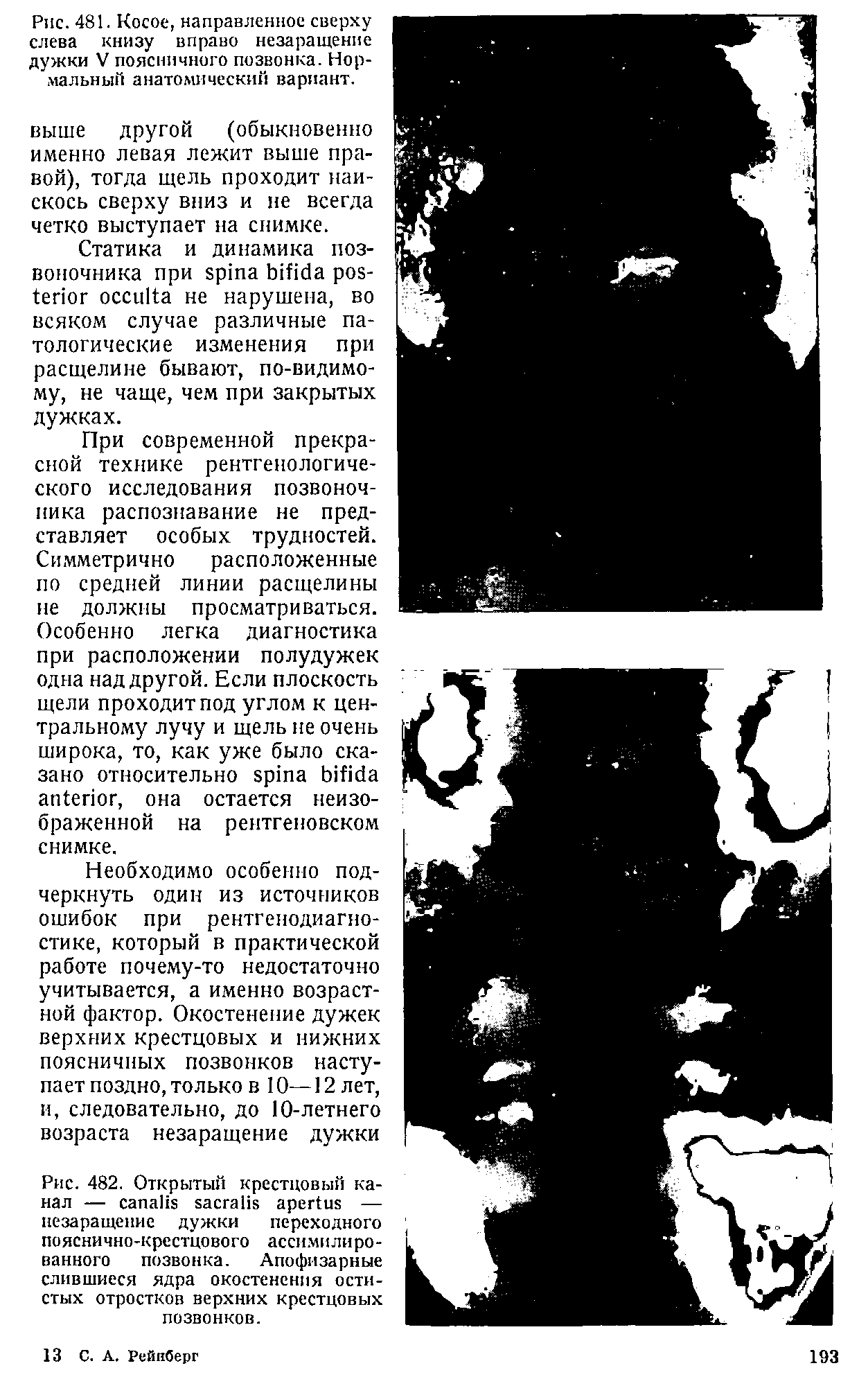 Рис. 482. Открытый крестцовый канал — — незаращение дужки переходного пояснично-крестцового ассимилированного позвонка. Апофизарные слившиеся ядра окостенения остистых отростков верхних крестцовых позвонков.