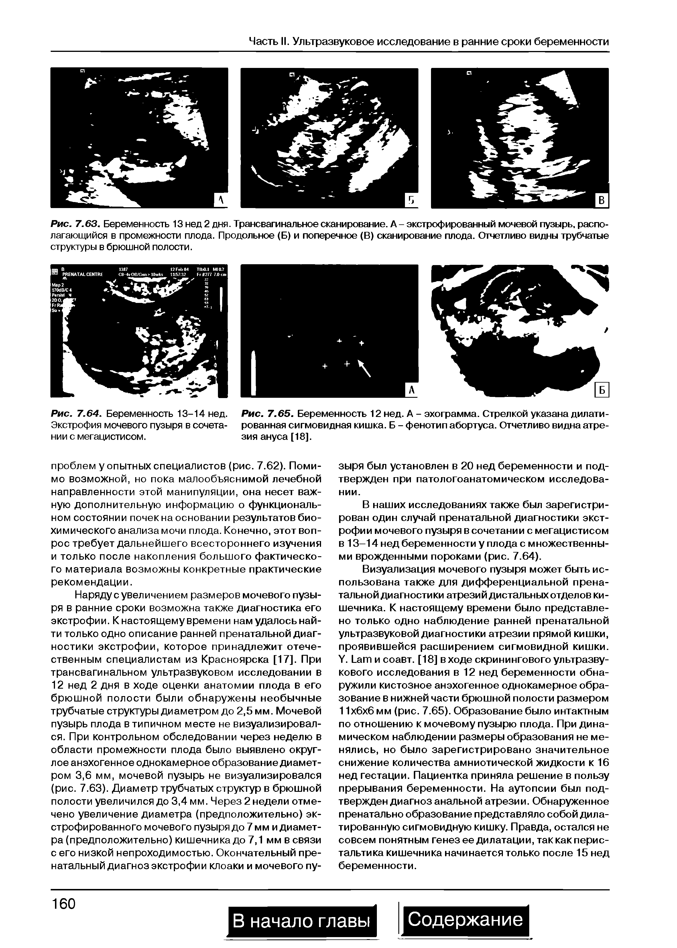 Рис. 7.64. Беременность 13-14 нед. Экстрофия мочевого пузыря в сочетании с мегацистисом.