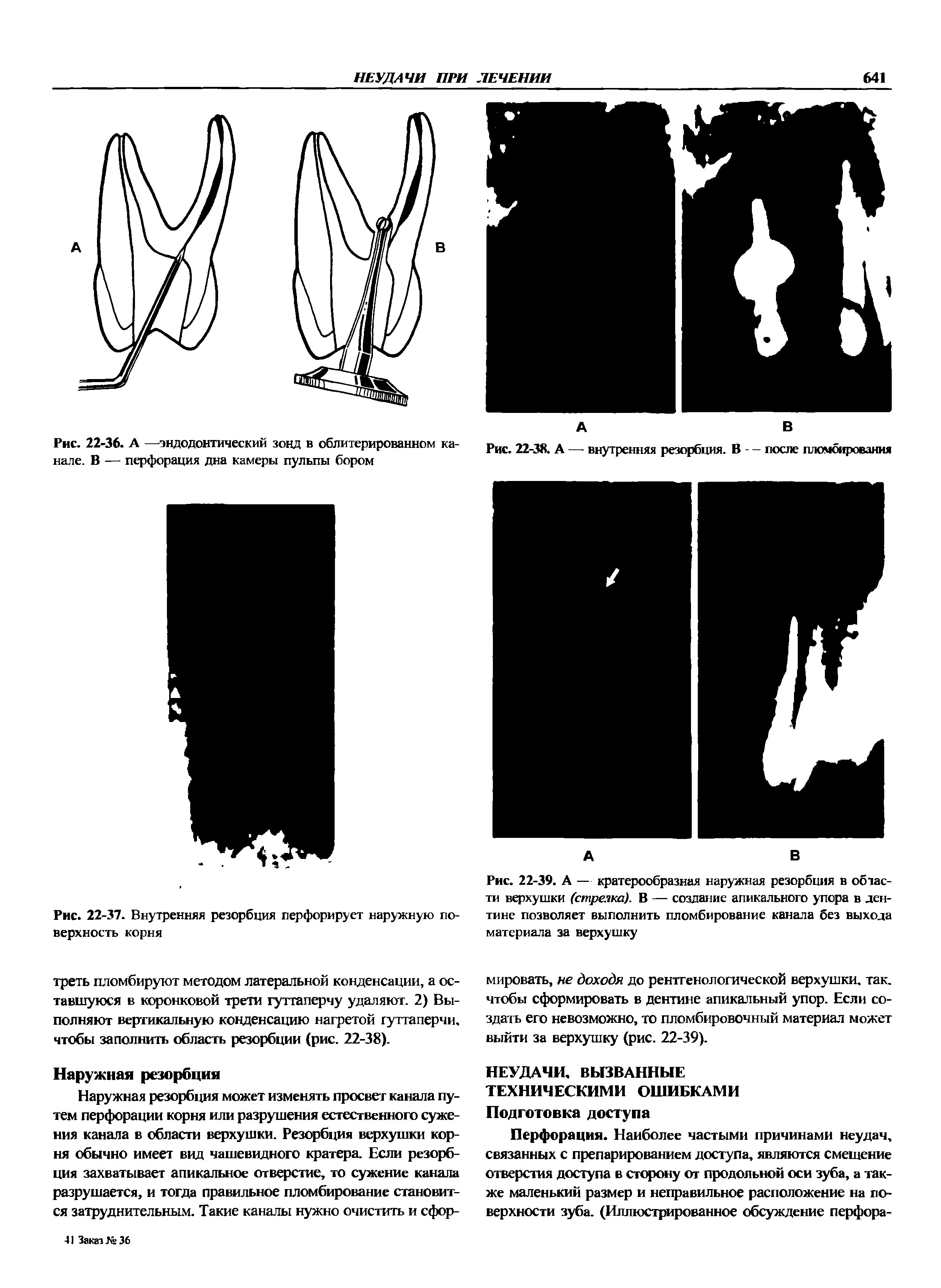 Рис. 22-39. А — кратерообразная наружная резорбция в области верхушки (стрелка). В — создание апикального упора в дентине позволяет выполнить пломбирование канала без выхода материала за верхушку...