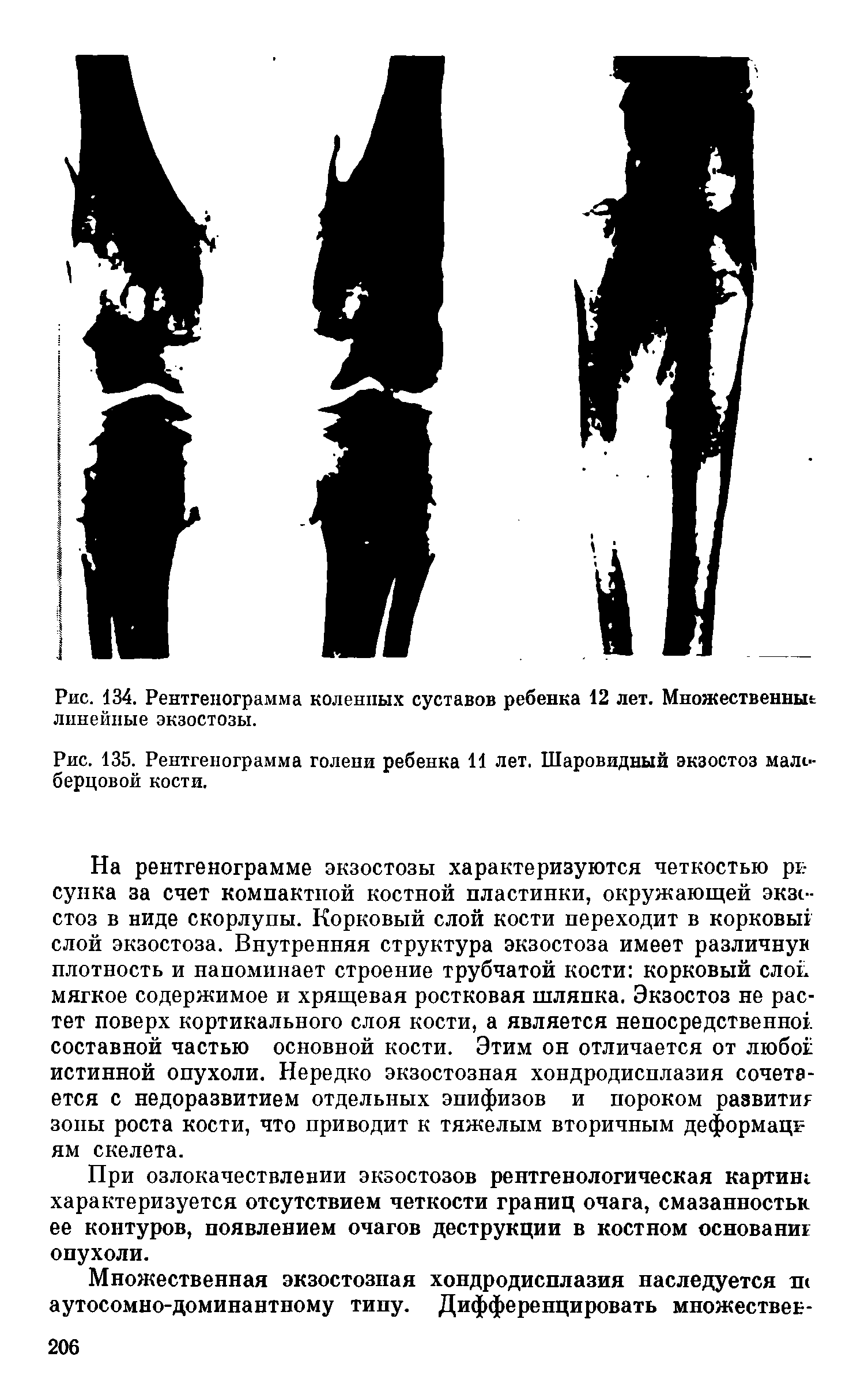 Рис. 135. Рентгенограмма голени ребенка И лет. Шаровидный экзостоз малоберцовой кости.