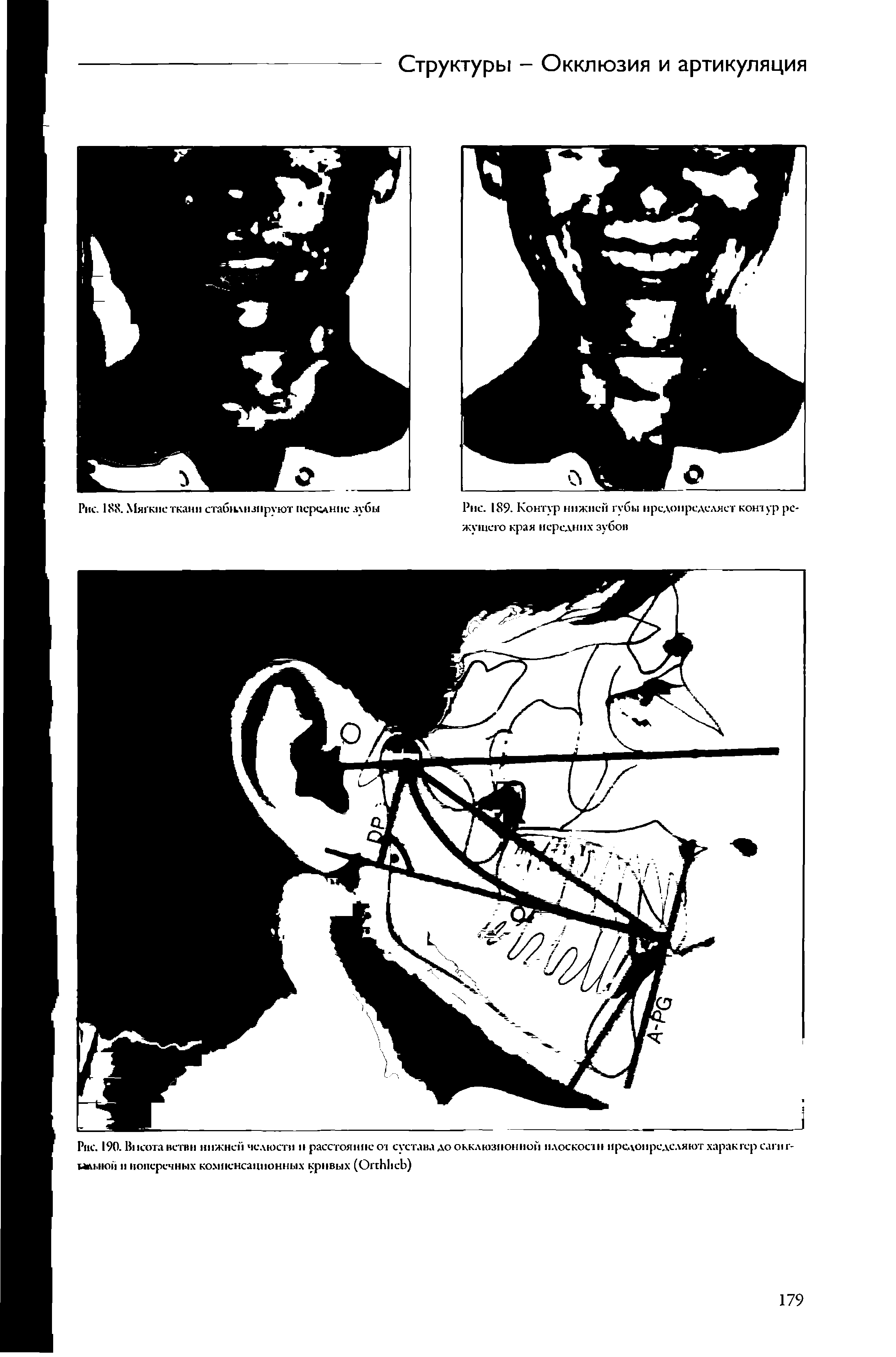 Рис. 190. Высота ветви нижней челюсти и расстояние от сустава до окклюзионной плоскости предопределяют характер сагнг-ЫА1.ВОИ н поперечных компенсационных кривых (ОггЫ сЬ)...