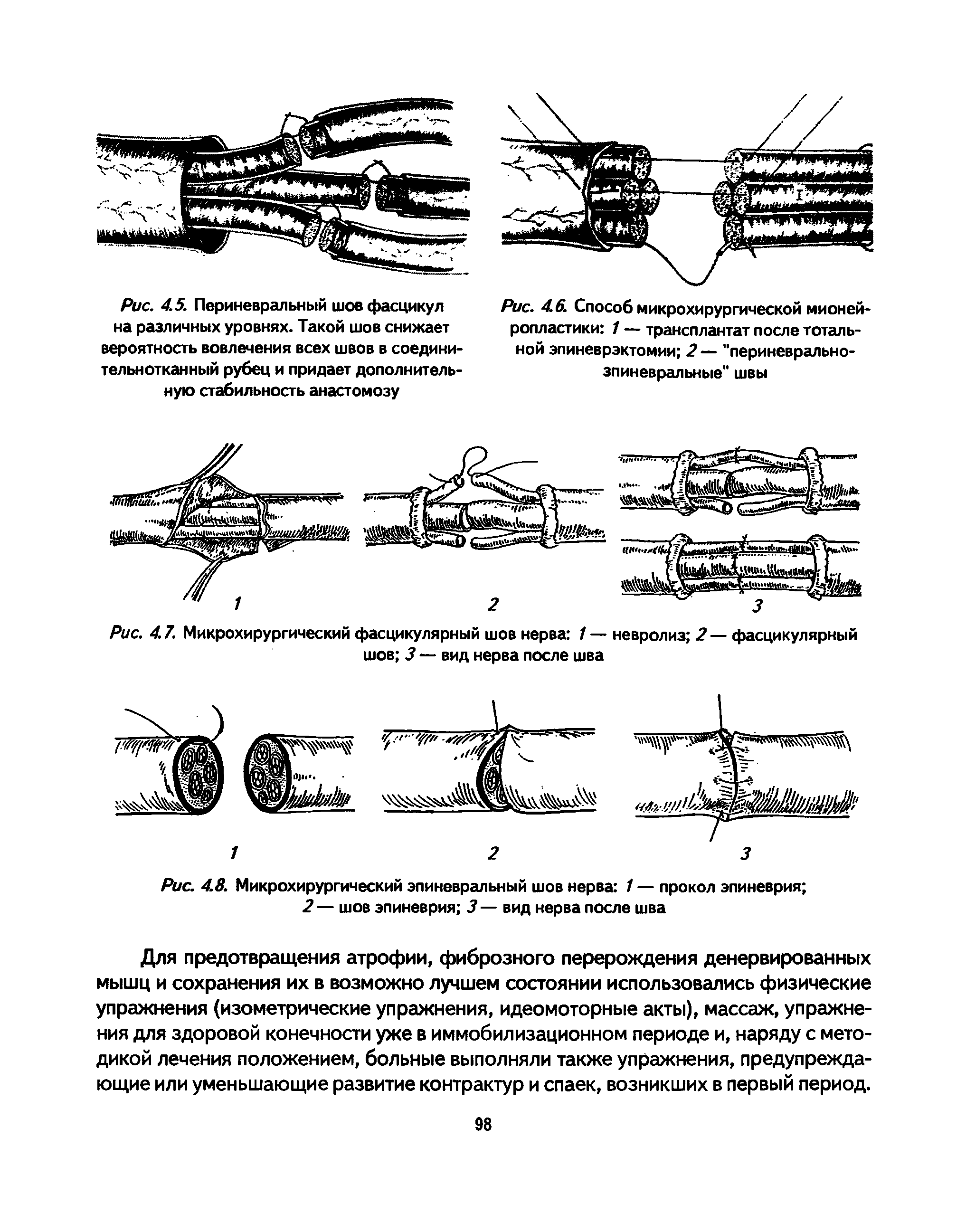 Рис. 4.7. Микрохирургический фасцикулярный шов нерва 1 — невролиз 2 — фасцикулярный шов 3 — вид нерва после шва...