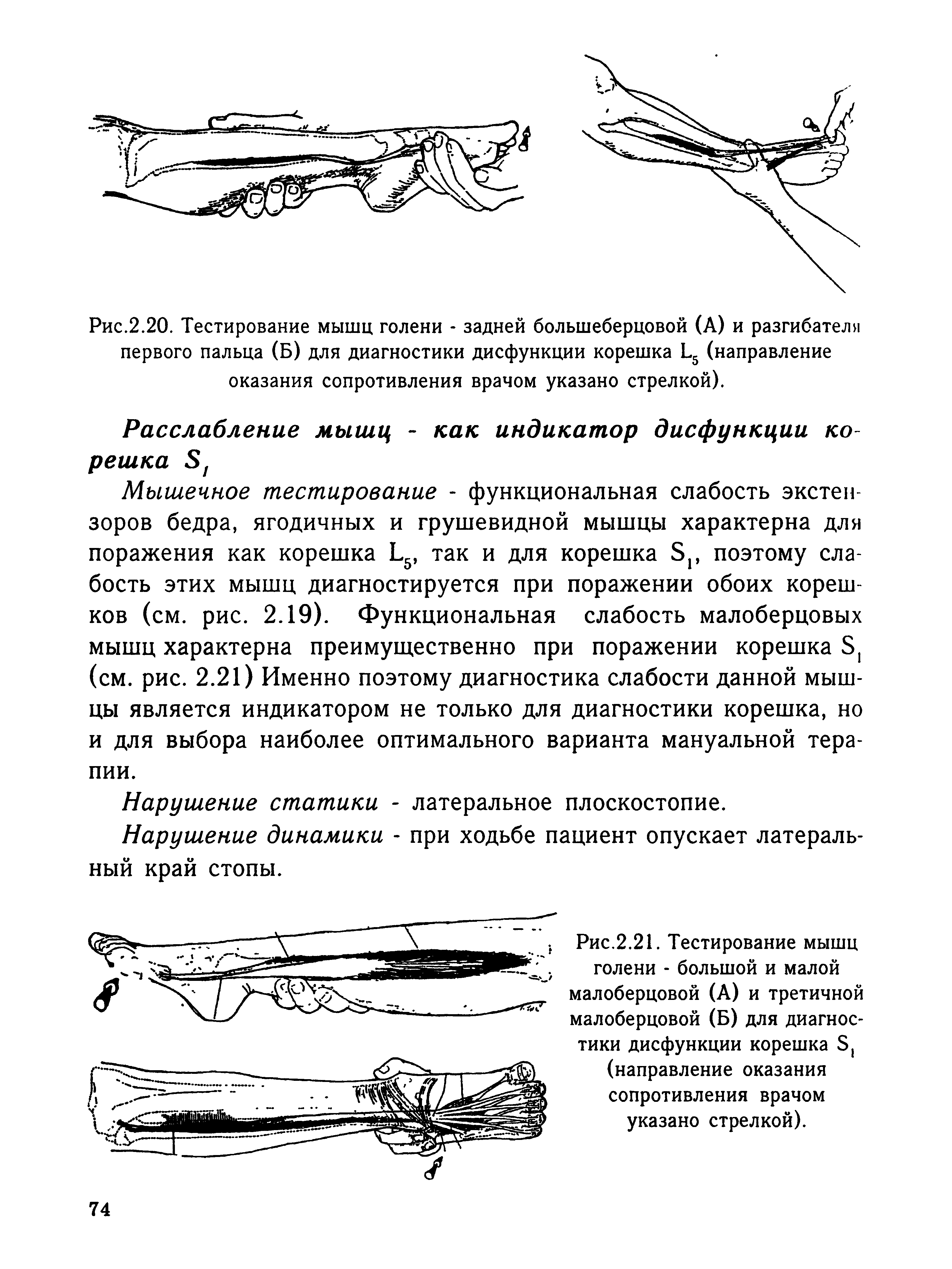 Рис.2.21. Тестирование мышц голени - большой и малой малоберцовой (А) и третичной малоберцовой (Б) для диагностики дисфункции корешка Б, (направление оказания сопротивления врачом указано стрелкой).