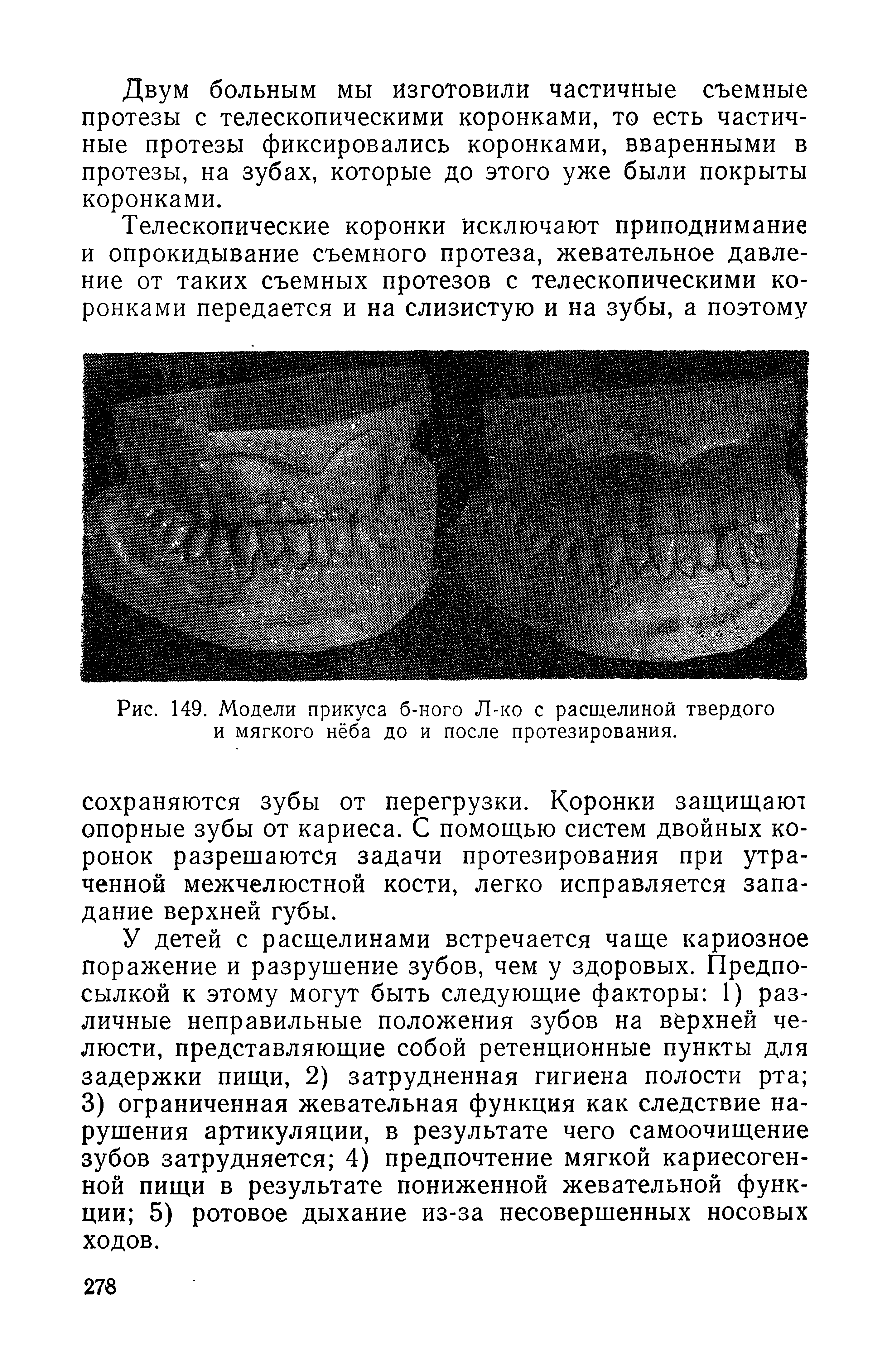 Рис. 149. Модели прикуса б-ного Л-ко с расщелиной твердого и мягкого нёба до и после протезирования.