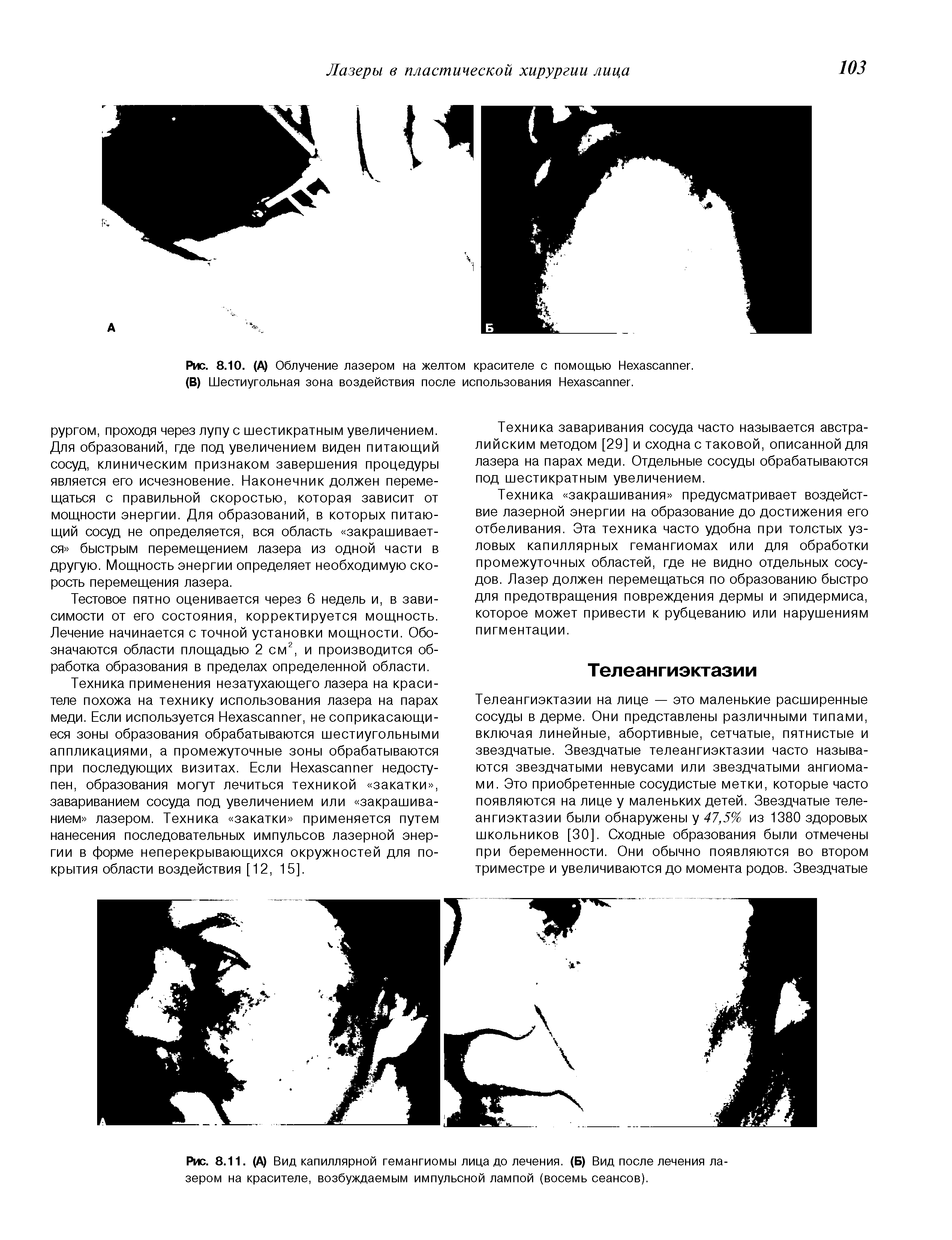 Рис. 8.11. (А) Вид капиллярной гемангиомы лица до лечения. (Б) Вид после лечения лазером на красителе, возбуждаемым импульсной лампой (восемь сеансов).